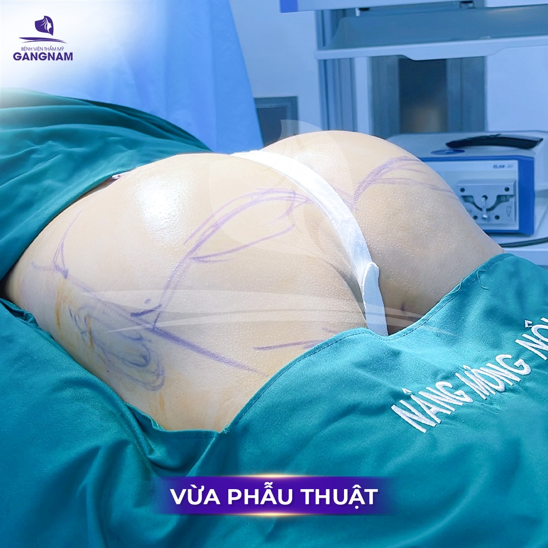 Nâng mông không sẹo: Bí quyết sở hữu vòng 3 căng tròn tự nhiên 5 Quy trình thực hiện nâng mông không sẹo an toàn