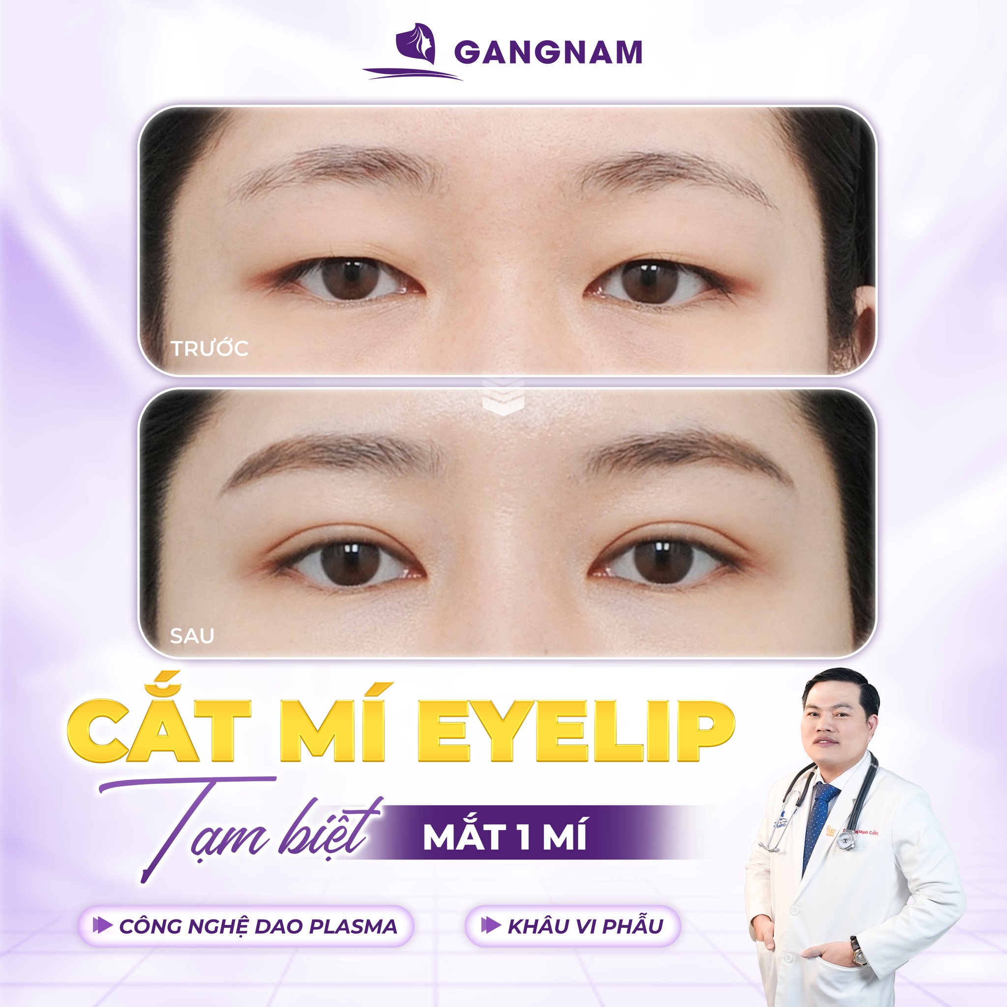 Nhấn Mí Eyelid: Giải Pháp Tạo Mí Đôi Tự Nhiên, Không Cần Phẫu Thuật 6 Nhấn mí Eyelid tại Thẩm mỹ Gangnam – Giải pháp tạo mí đôi tự nhiên, chuẩn phong cách Hàn Quốc