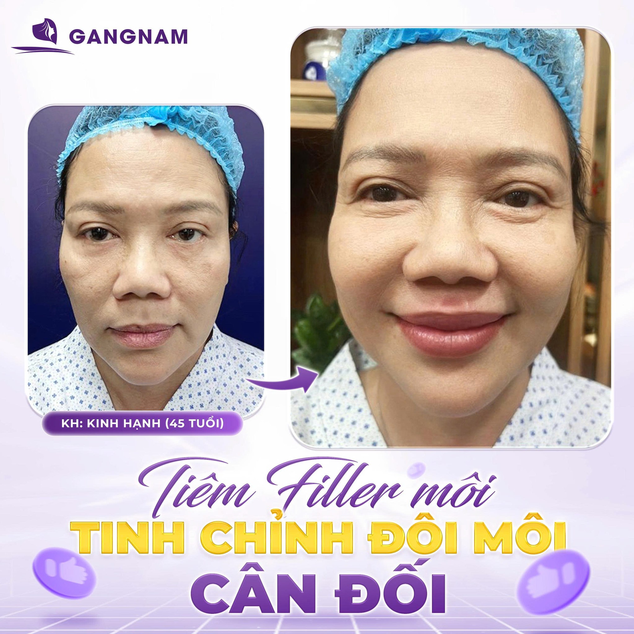 Tiêm filler tạo hình môi: Bí quyết sở hữu đôi môi hoàn hảo tự nhiên 5 Các dáng môi phổ biến khi tiêm filler tạo hình môi