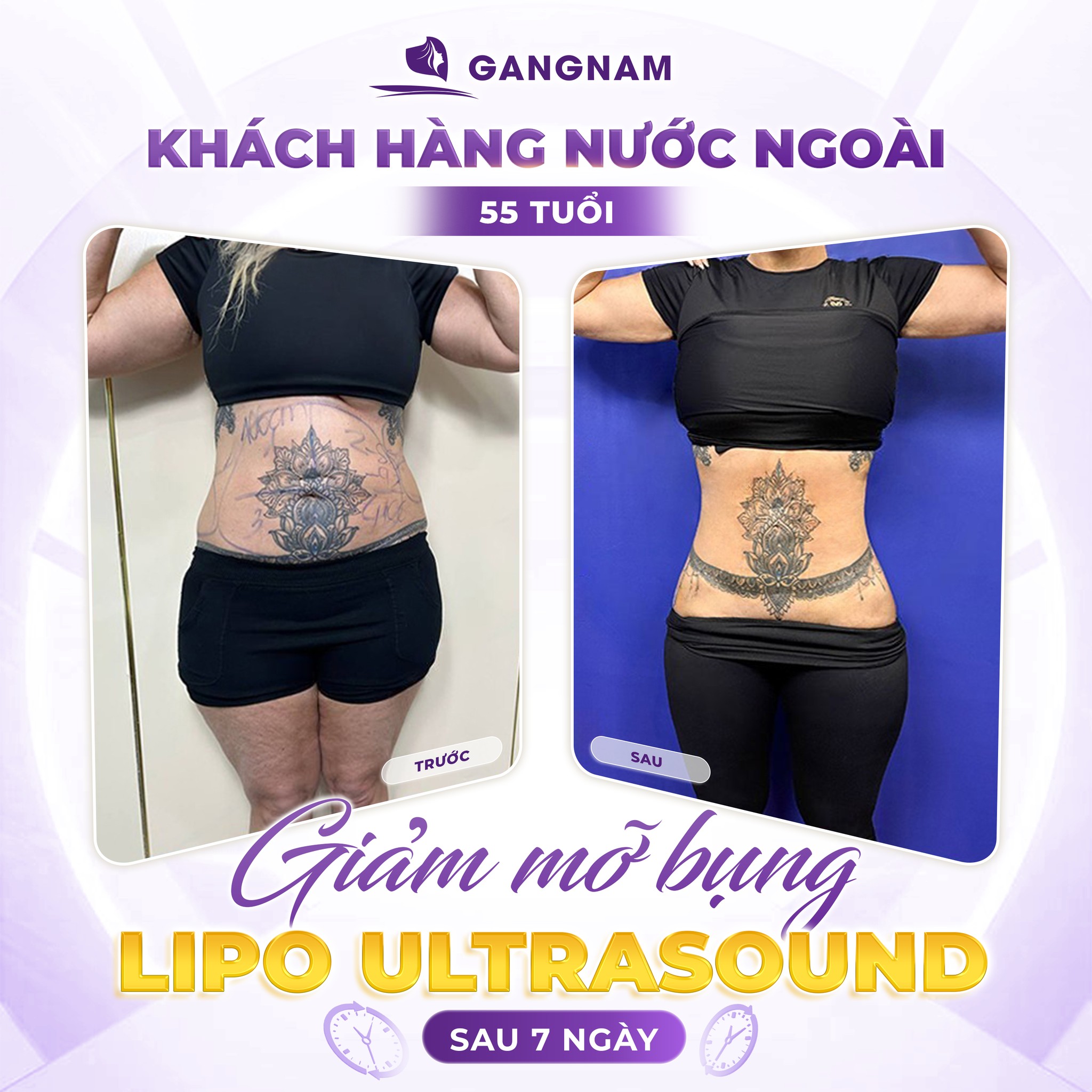 Hút mỡ eo thon gọn: Bí quyết sở hữu đường cong hoàn hảo 5 Lợi ích vượt trội của hút mỡ eo thon gọn so với phương pháp khác