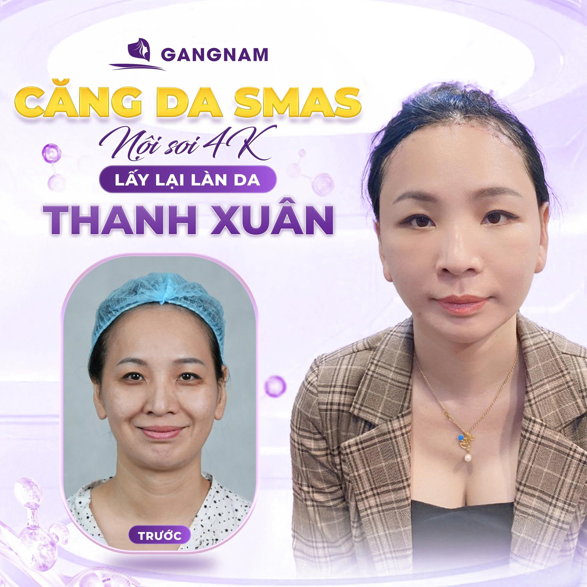 Căng da SMAS: Giải pháp trẻ hóa toàn diện cho làn da chảy xệ 4 Căng da SMAS là gì và tại sao nó khác biệt?