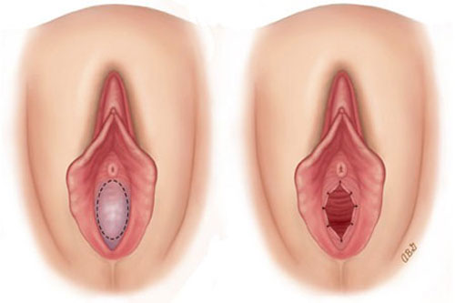 Khâu màng trinh – Giải pháp thẩm mỹ vùng kín mang ý nghĩa tâm lý và sức khỏe 4 Khâu màng trinh là gì ?