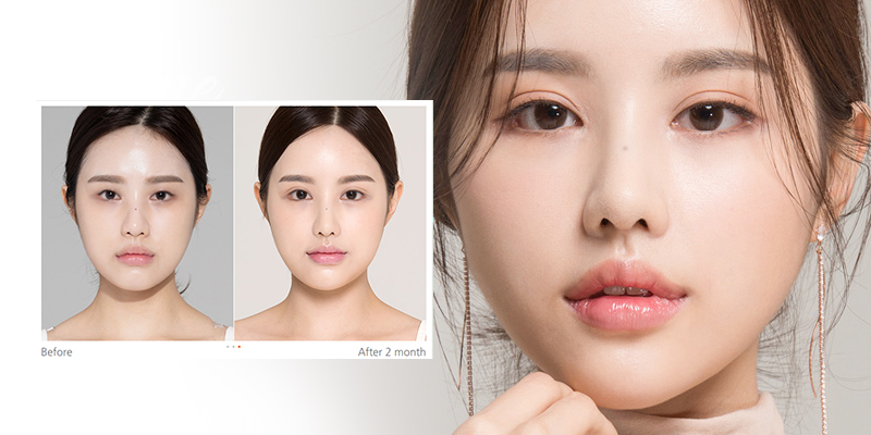 Cắt mí Hàn Quốc 7D – Bí quyết sở hữu đôi mắt hai mí đẹp hoàn hảo 4 Cắt mí Hàn Quốc 7D là gì?