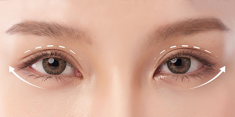 Cắt mí Eyelid tự nhiên – Bí quyết sở hữu đôi mắt hai mí đẹp hoàn hảo 4 Cắt mí Eyelid tự nhiên là gì?