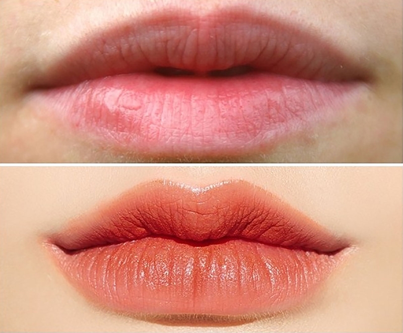 Cắt môi trái tim không sẹo là gì?