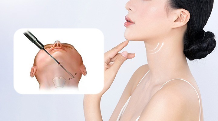 Hút Mỡ Thừa Cằm: Bí Quyết Sở Hữu Gương Mặt Thon Gọn V-Line 4 Hút mỡ thừa cằm là gì?