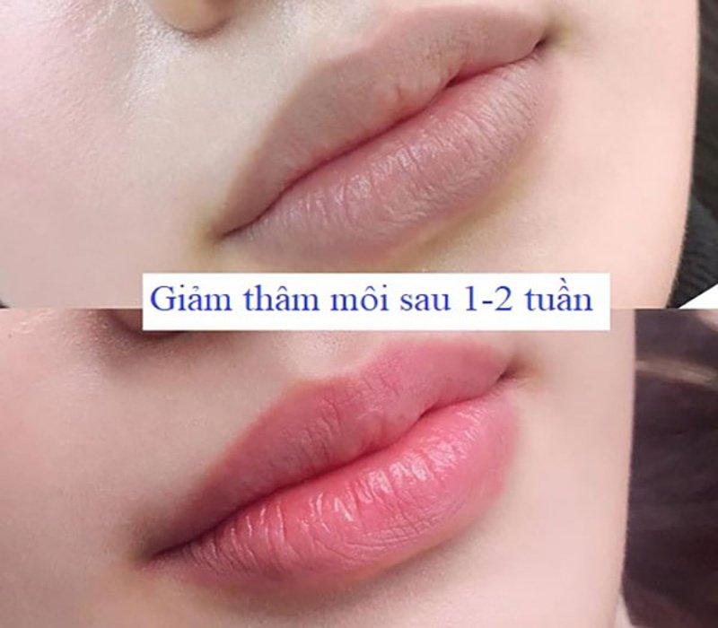 Trẻ hóa môi bằng laser – Bí quyết sở hữu đôi môi hồng căng mọng tự nhiên 5 Đối tượng nào nên thực hiện trẻ hóa môi bằng laser ngay hôm nay?