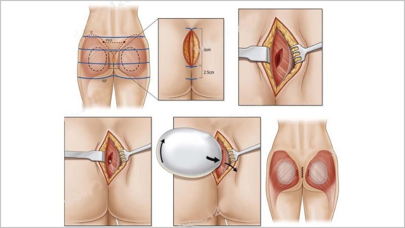 Đặt túi mông quyến rũ: Bí quyết sở hữu vòng 3 hoàn hảo và gợi cảm 4 Lý do chọn đặt túi mông quyến rũ thay vì các phương pháp khác