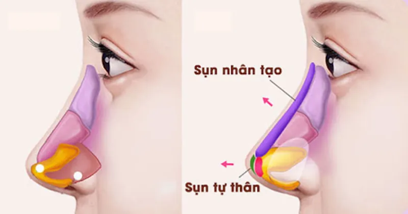 Nâng Mũi Cấu Trúc Toàn Phần: Giải Pháp Hoàn Hảo Cho Dáng Mũi Tự Nhiên 4 Nâng mũi cấu trúc toàn phần là gì?