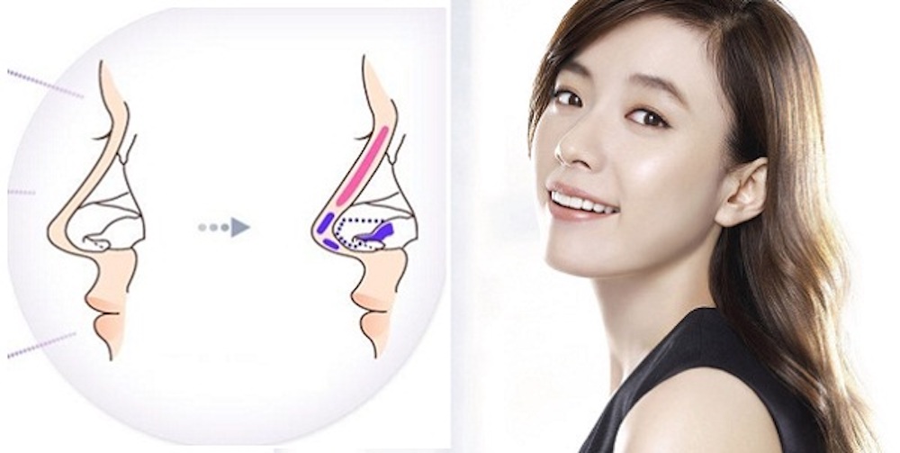 Nâng mũi cấu trúc tự nhiên – Bí quyết sở hữu dáng mũi đẹp hoàn hảo 4 Nâng mũi cấu trúc tự nhiên khác biệt ở điểm nào?