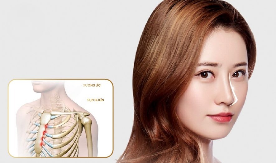 Nâng mũi cấu trúc sụn sườn: Giải pháp thẩm mỹ mũi cao cấp và bền vững 4 Nâng mũi cấu trúc sụn sườn là gì?