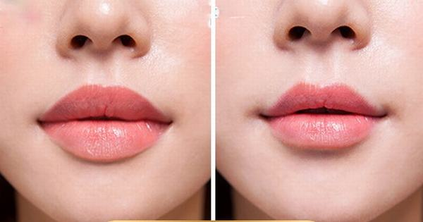 Thu gọn môi dày – Bí quyết sở hữu đôi môi mỏng tự nhiên, cân đối 4 Thu gọn môi dày là gì?