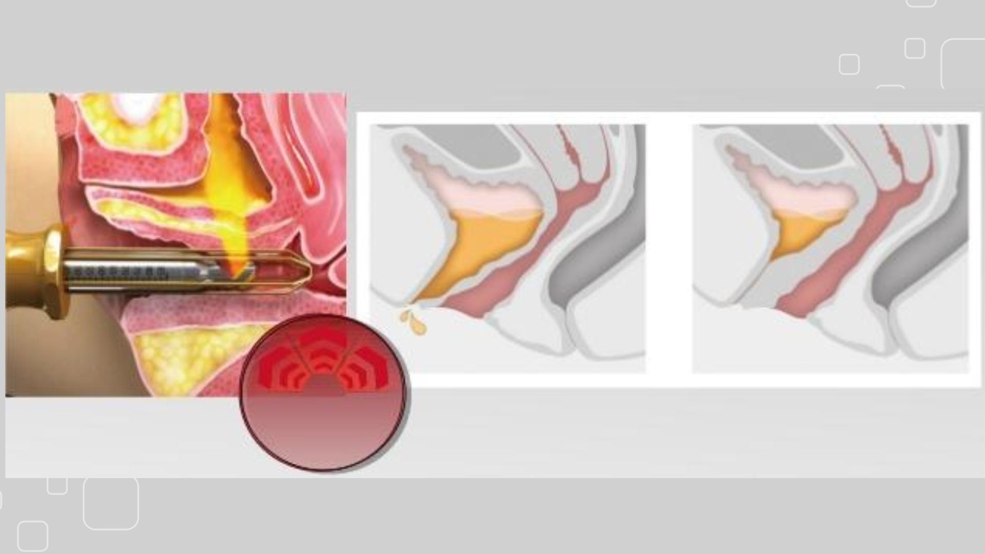 Trẻ hóa âm đạo bằng PRP: Giải pháp tự nhiên phục hồi vùng kín 4 Công nghệ PRP trong trẻ hóa âm đạo bằng PRP hoạt động như thế nào?