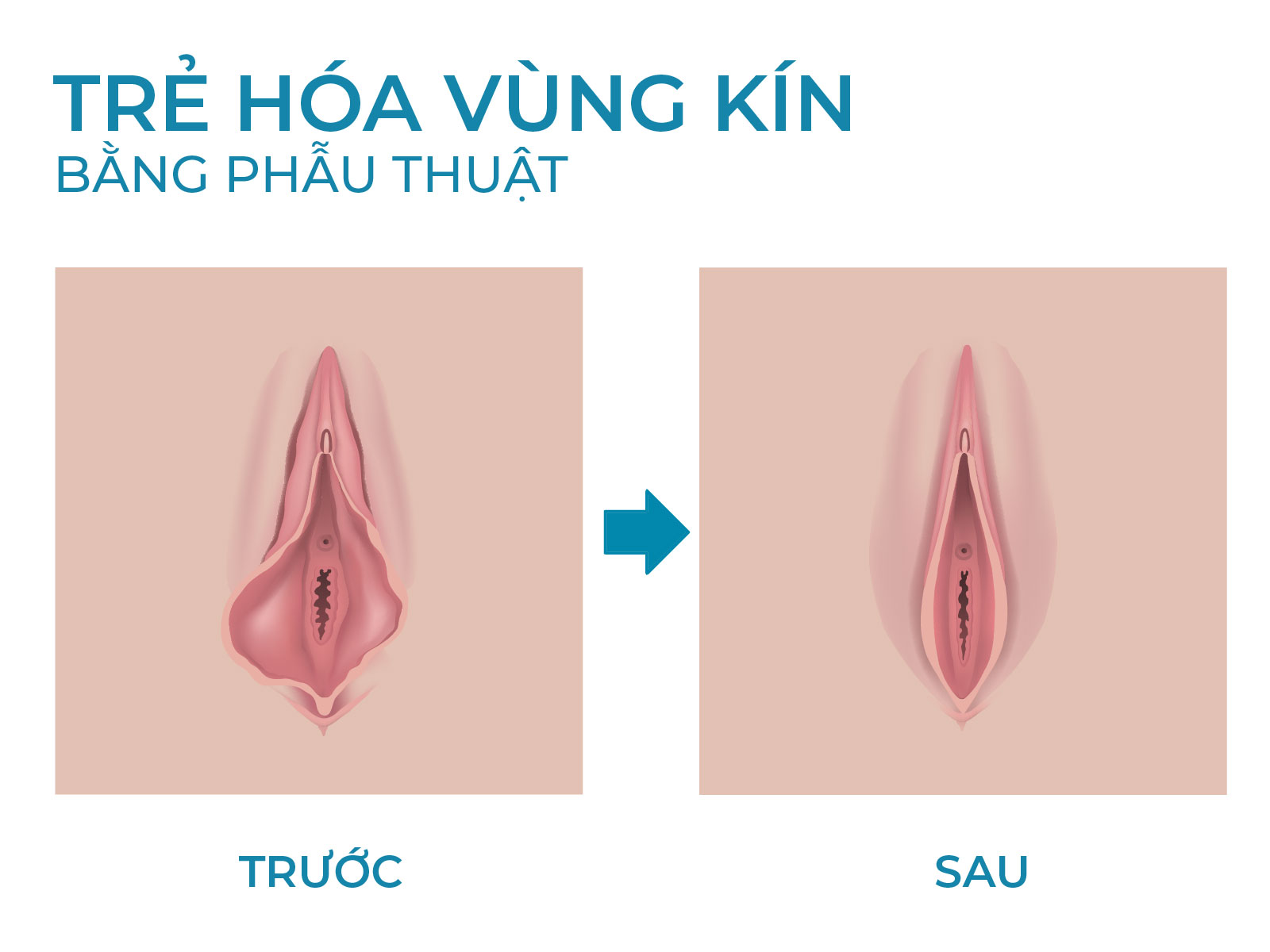 Thu nhỏ môi âm đạo – Giải pháp giúp vùng kín tự tin và thoải mái hơn 4 Thu nhỏ môi âm đạo là gì?