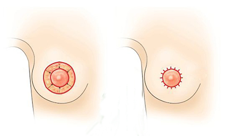 Thu gọn nhũ hoa thẩm mỹ: Giải pháp hoàn hảo cho vòng 1 cân đối tự nhiên 4 Thu gọn nhũ hoa thẩm mỹ là gì và đối tượng phù hợp