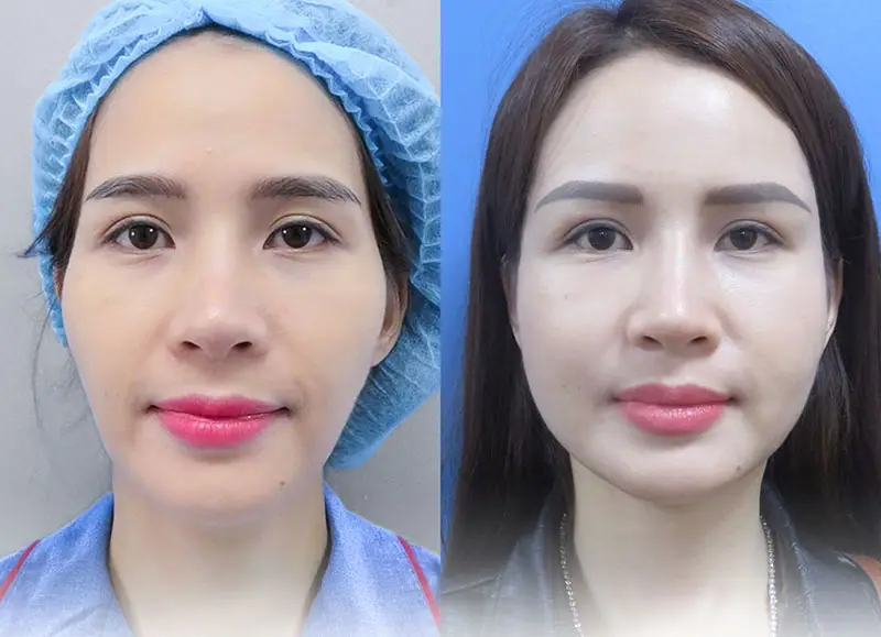 Cấy mỡ má đầy đặn: Giải pháp trẻ hóa khuôn mặt tự nhiên và lâu dài 4 Cấy mỡ má đầy đặn là gì?