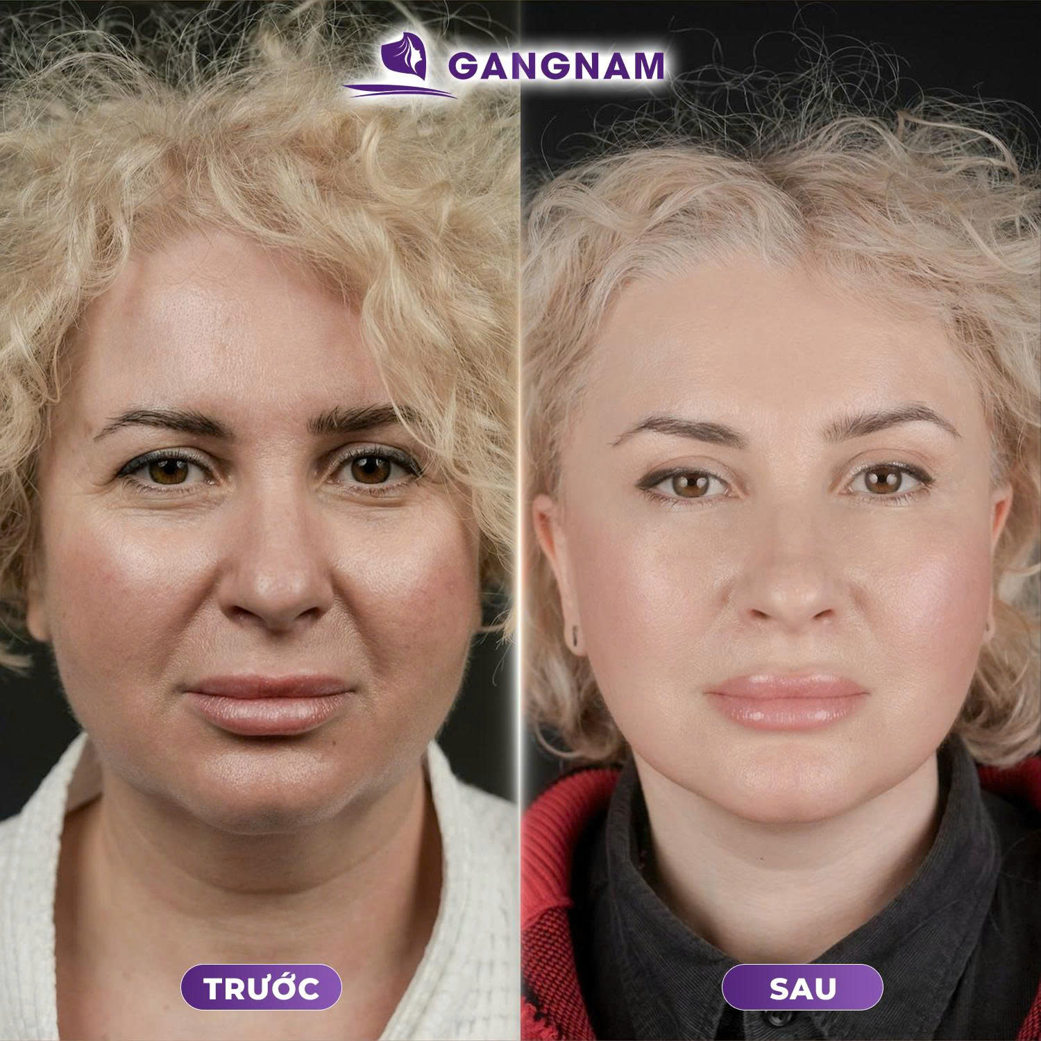 Đối tượng nào phù hợp với căng da mặt SMAS 4K chuẩn y khoa?