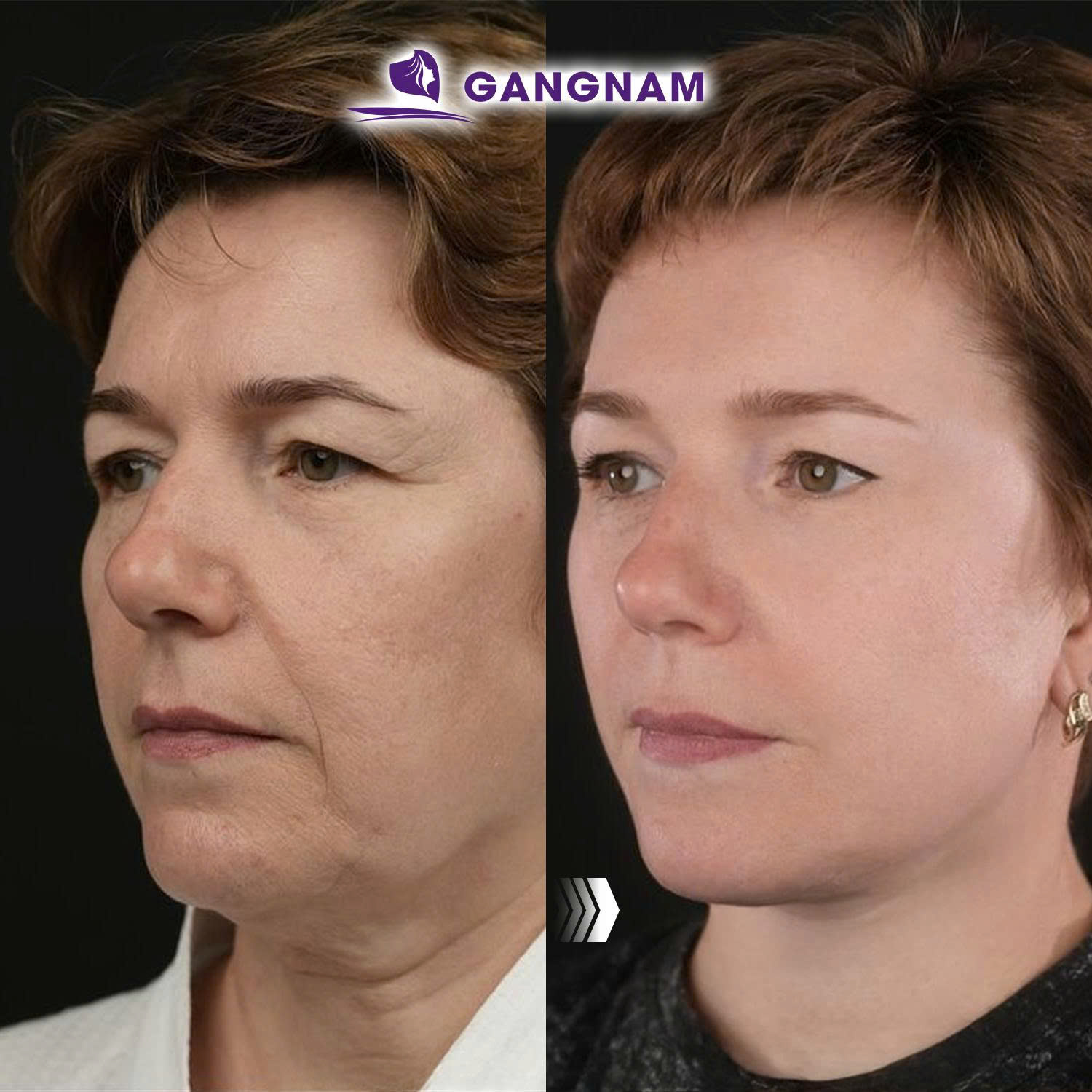 Căng da mặt SMAS 4K chuẩn y khoa là gì?