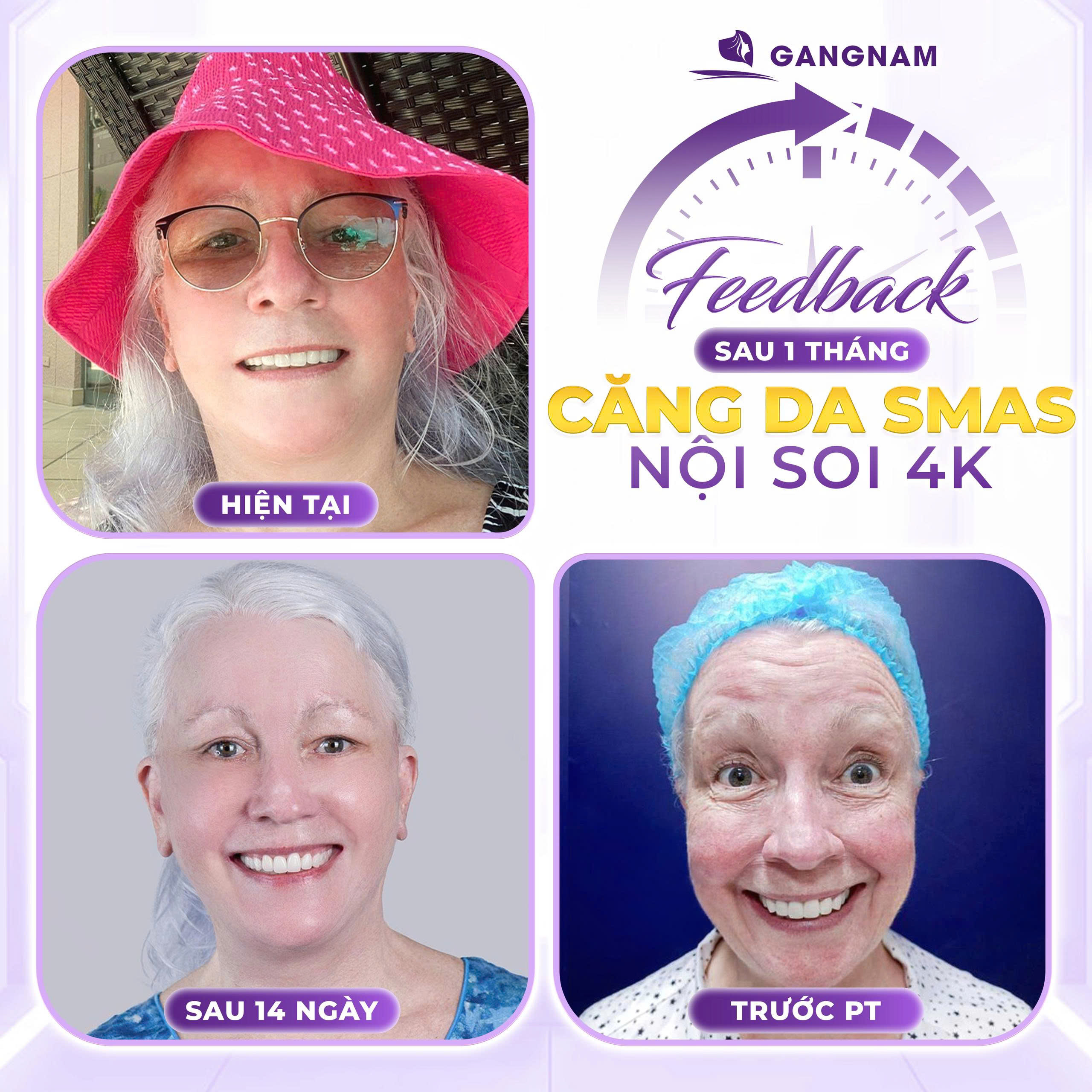 Thẩm mỹ Gangnam – Địa chỉ uy tín hàng đầu cho phẫu thuật căng da mặt SMAS 4K