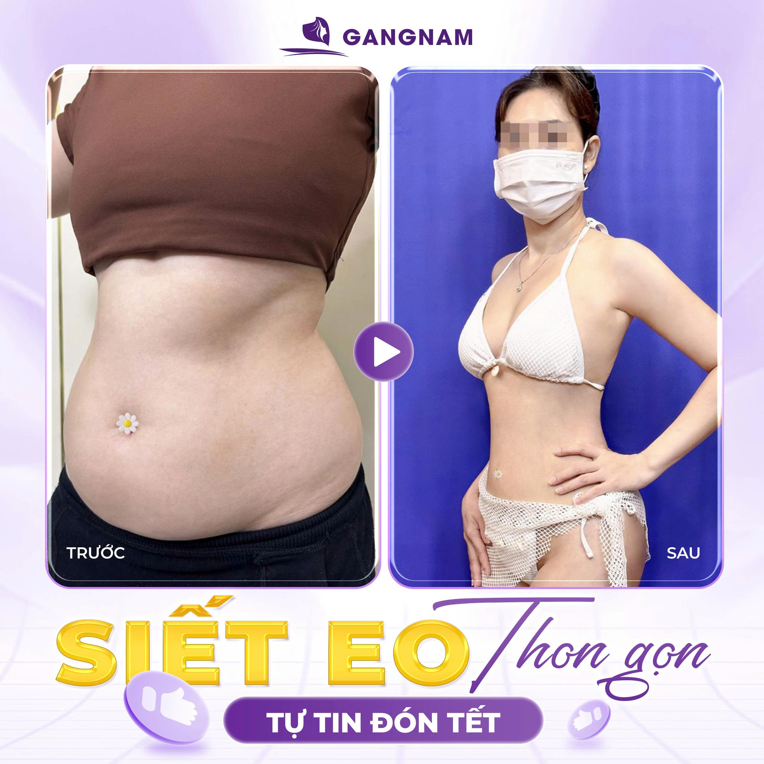 Hút mỡ eo an toàn – Bí quyết sở hữu vòng eo 56-60cm mà không để lại biến chứng 6 Hút mỡ eo an toàn tại thẩm mỹ Gang Nam – Giải pháp hoàn hảo cho vòng eo thon gọn