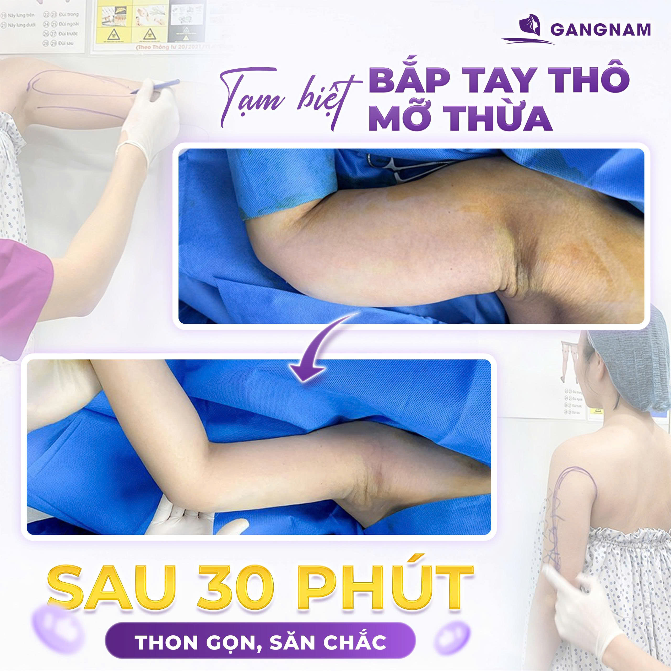 Hút mỡ cánh tay: Giải pháp thon gọn bắp tay an toàn và hiệu quả 5 Quy trình hút mỡ cánh tay tiêu chuẩn tại cơ sở uy tín