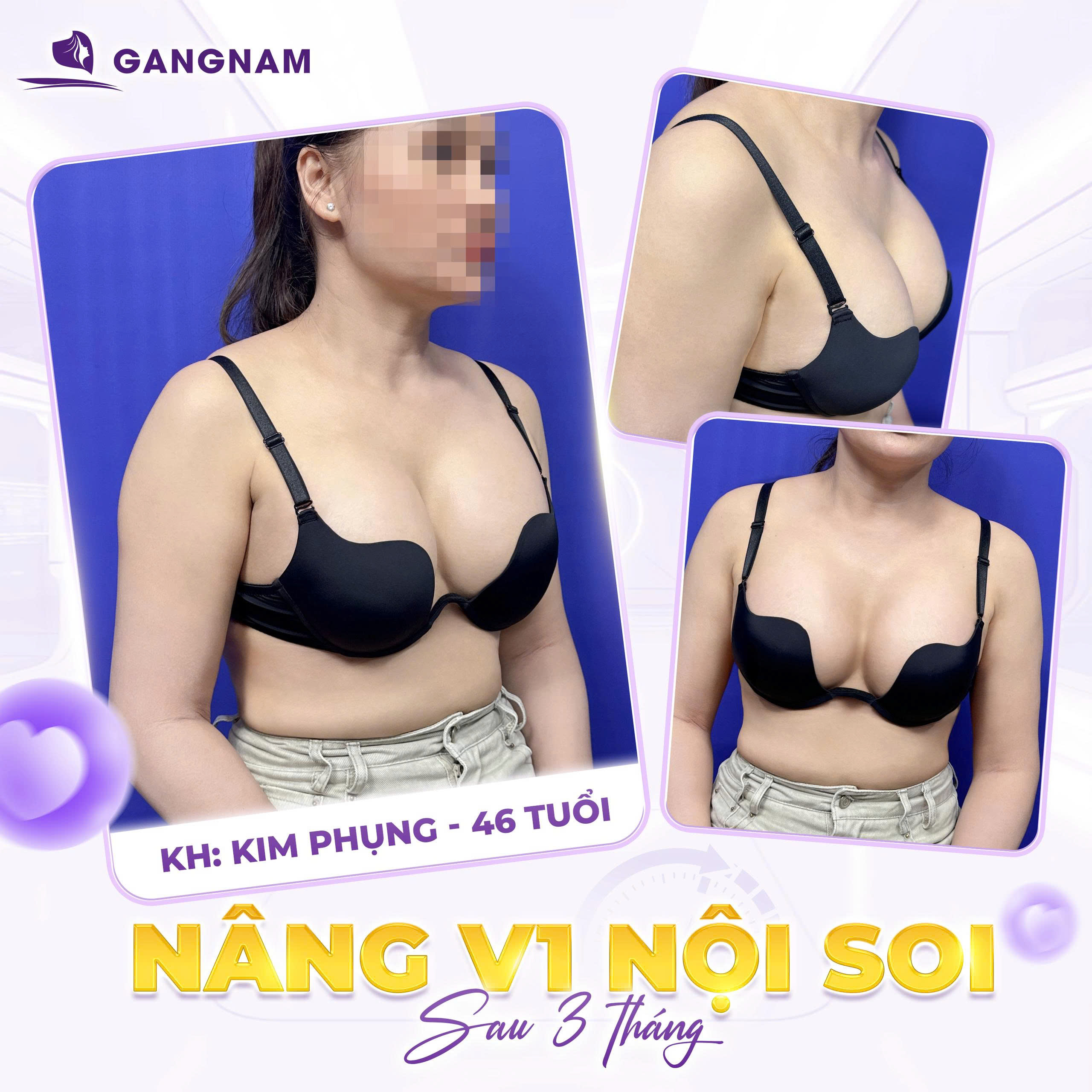 Nâng ngực túi độn nội soi 4K – Công nghệ thẩm mỹ ngực đẹp tự nhiên 6 Thẩm mỹ Gangnam – Nơi kiến tạo vẻ đẹp chuẩn tinh tế Hàn Quốc