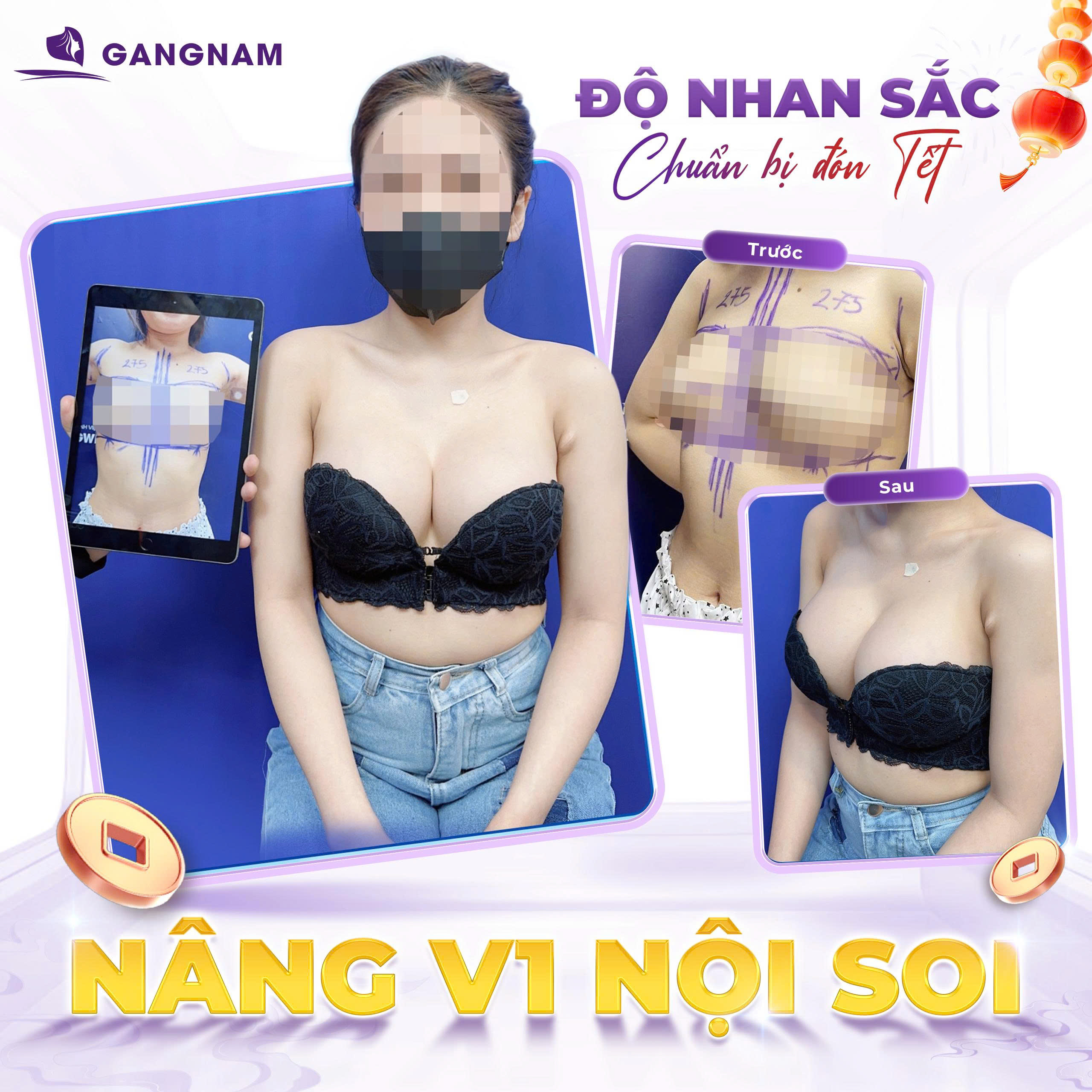 Nâng Ngực Nội Soi Túi Nano Chip – Công Nghệ Đỉnh Cao Cho Vòng 1 Hoàn Hảo 6 Thẩm mỹ Gangnam – Nơi hội tụ công nghệ làm đẹp hiện đại và đội ngũ bác sĩ chuyên môn cao