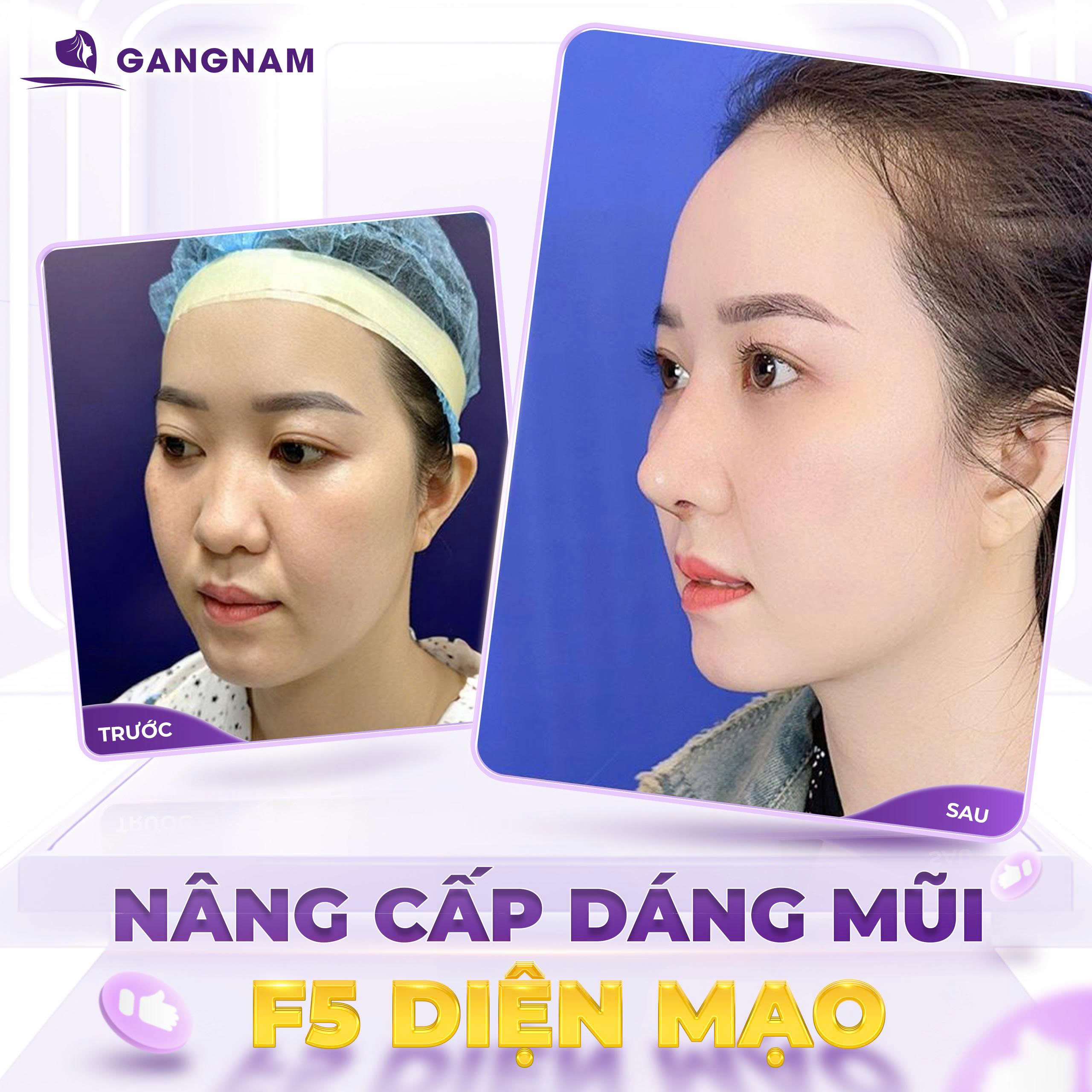 Nâng mũi sụn sườn tự nhiên tại Thẩm mỹ Gangnam – Đỉnh cao của nghệ thuật tạo hình
