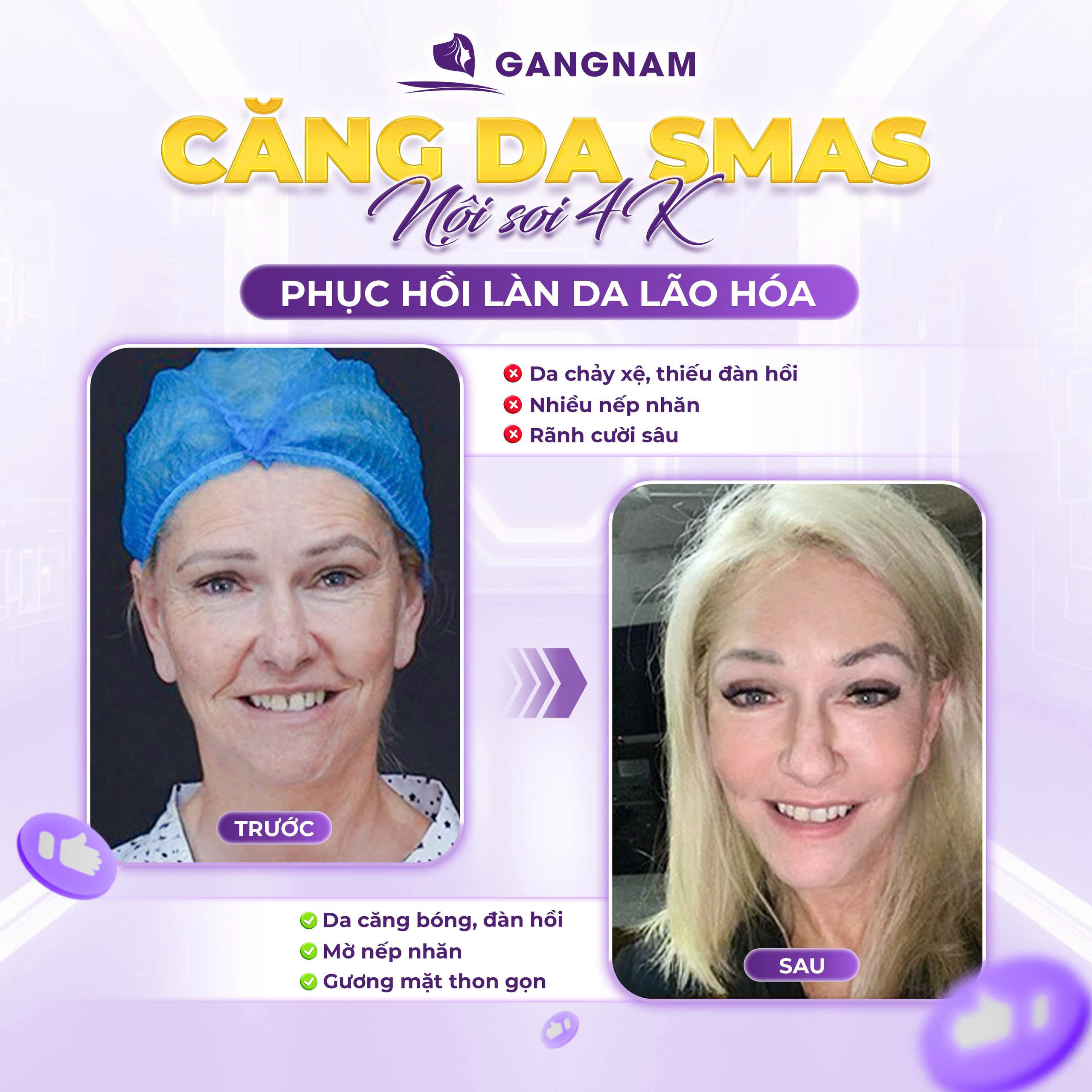 Căng da mặt nội soi 4K khác gì so với các phương pháp cũ?