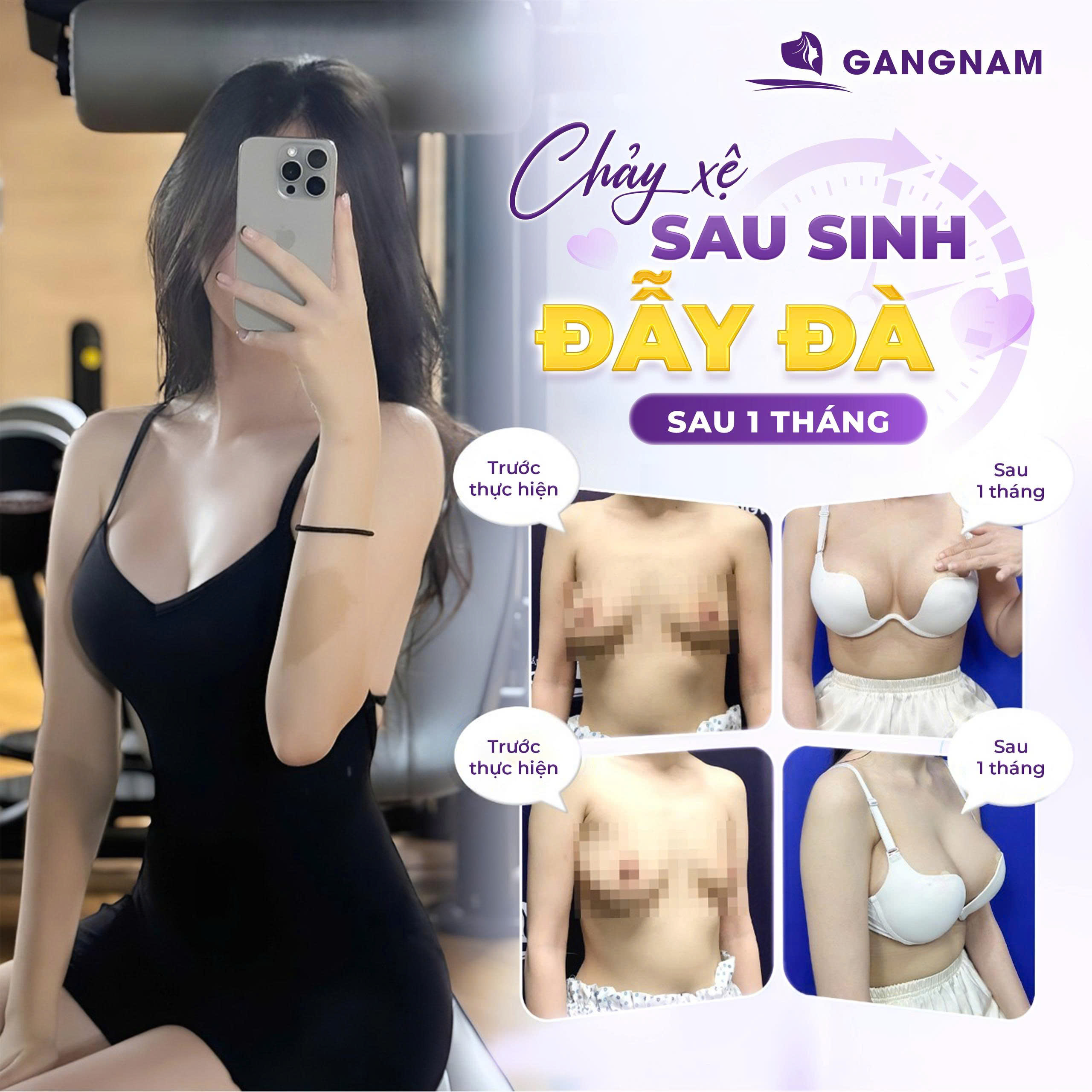 Nâng ngực treo sa trễ – Giải pháp hoàn hảo cho vòng 1 chảy xệ sau sinh 6 Nâng ngực treo sa trễ – Giải pháp toàn diện giúp khôi phục dáng ngực cao, căng tròn và trẻ trung sau sinh hoặc lão hóa