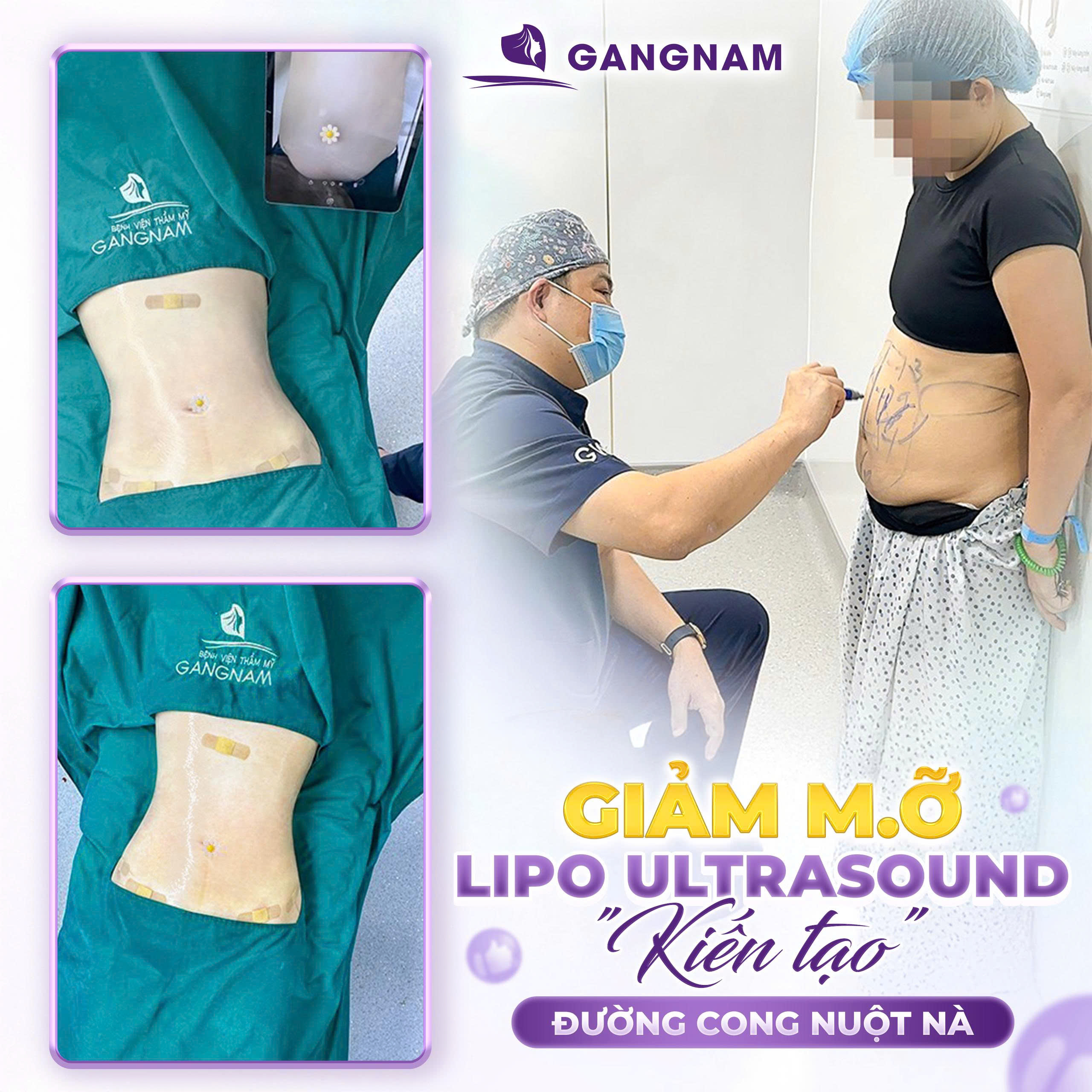 Hút mỡ bụng Lipo: Công nghệ hiện đại giúp sở hữu vòng eo thon gọn 6 Hút mỡ bụng Lipo – Giải pháp thẩm mỹ hiện đại cho vòng eo thon gọn