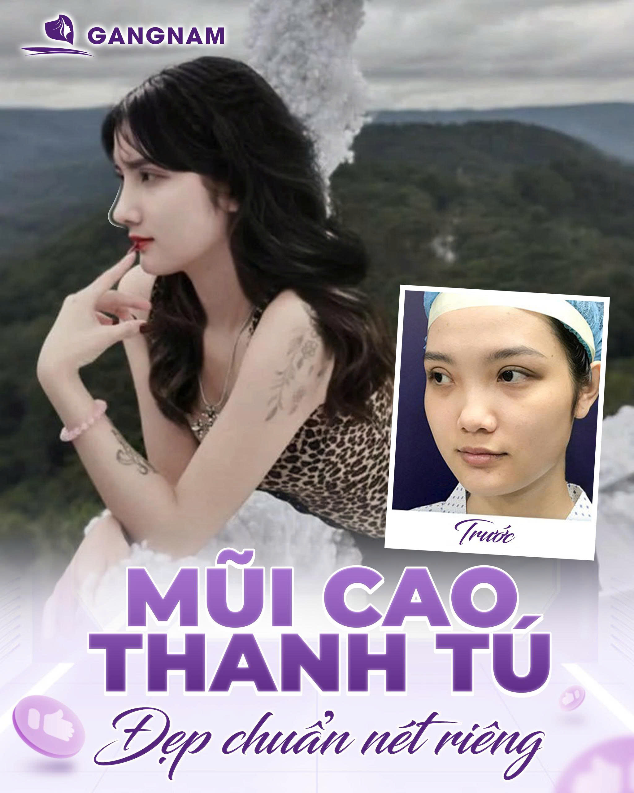 Nâng mũi cấu trúc tự nhiên – Bí quyết sở hữu dáng mũi đẹp hoàn hảo 6 Nâng Mũi Cấu Trúc Tự Nhiên – Giải Pháp Hoàn Hảo Cho Dáng Mũi Thanh Thoát, An Toàn Và Bền Vững