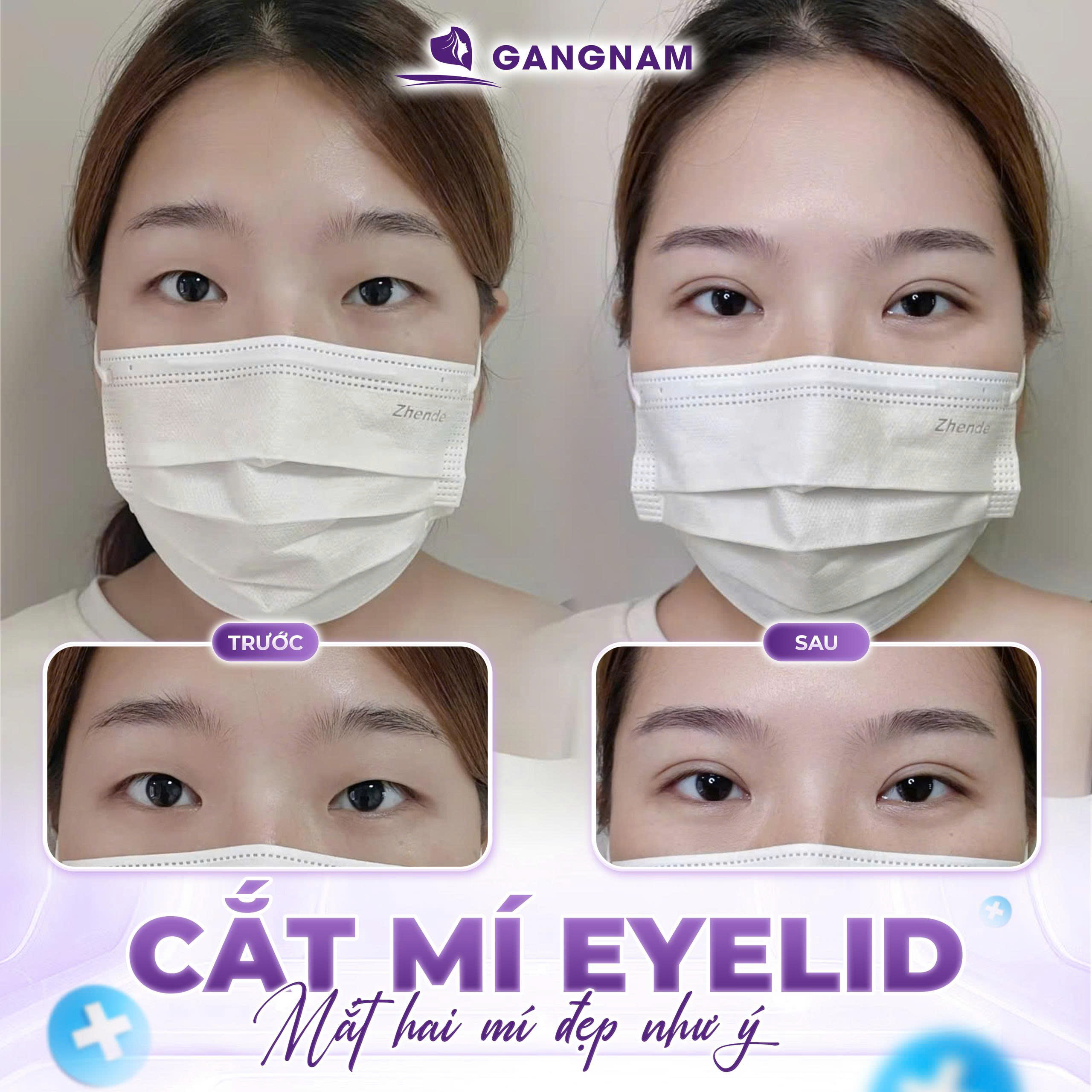 Vì Sao Cắt Mí Mắt Eyelid Tại Thẩm Mỹ Gangnam Được Ưu Chuộng?