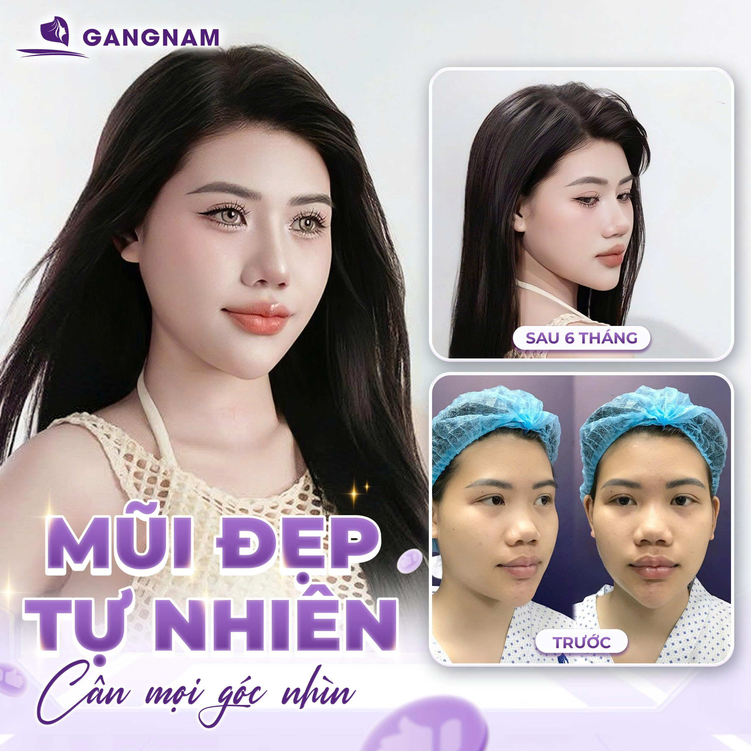 Ưu điểm vượt trội khiến nâng mũi S line luôn đứng đầu xu hướng