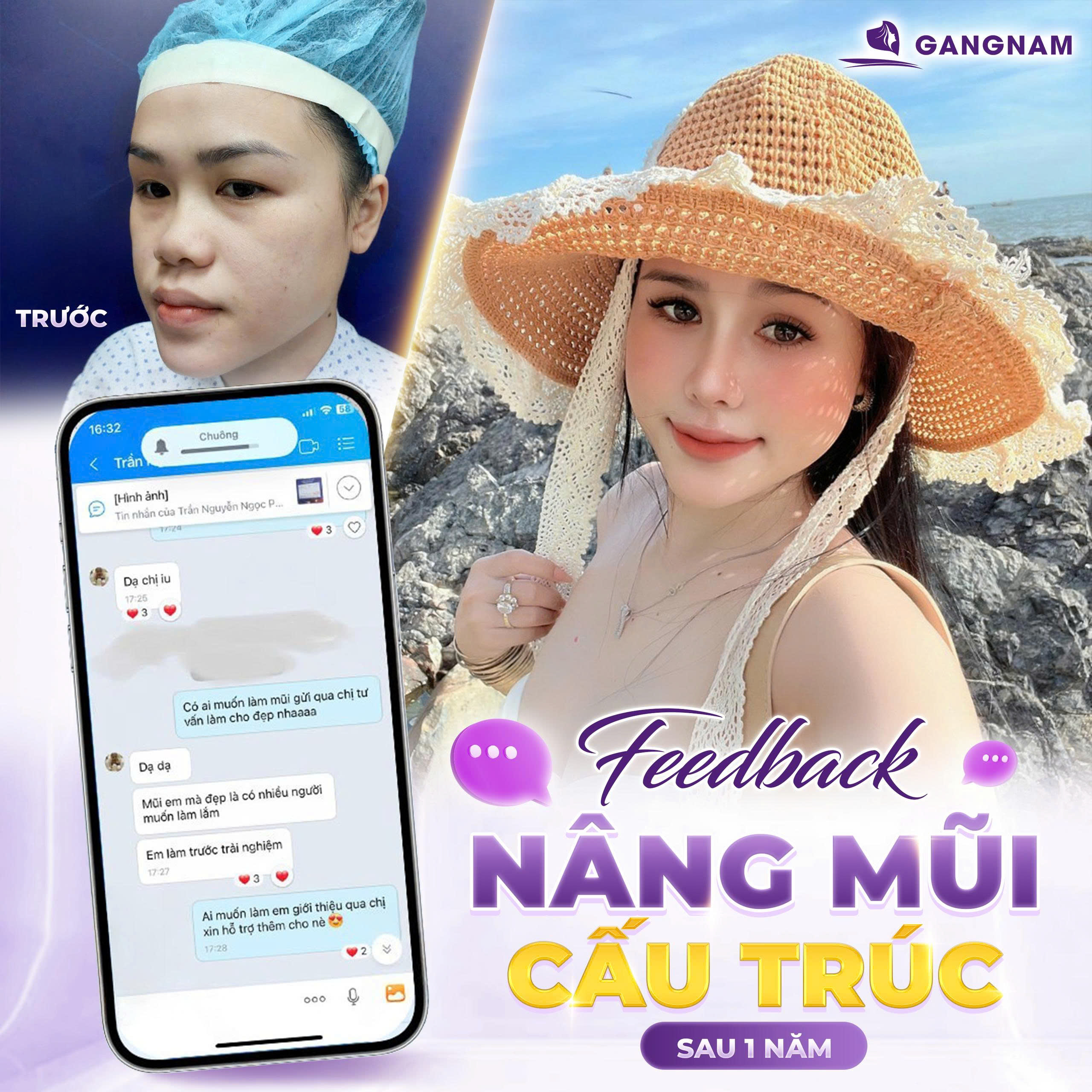 Nâng mũi cấu trúc sụn sườn: Giải pháp thẩm mỹ mũi cao cấp và bền vững 6 Nâng mũi cấu trúc sụn sườn – Giải pháp tái tạo dáng mũi đỉnh cao tại Thẩm mỹ Gangnam