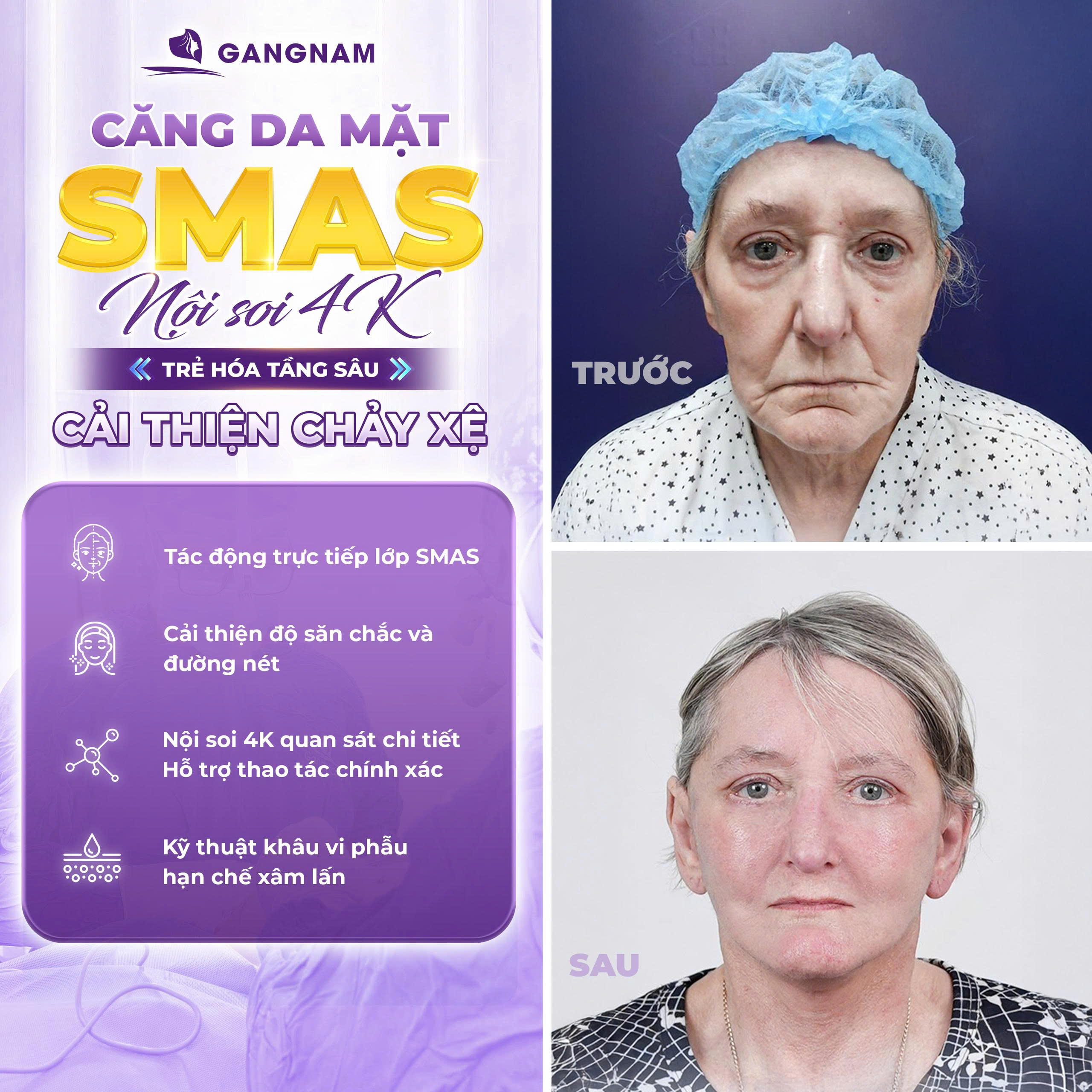 Căng da mặt nội soi SMAS 4K: Bí quyết trẻ hóa toàn diện và bền vững 5 Ai nên chọn căng da mặt nội soi SMAS 4K