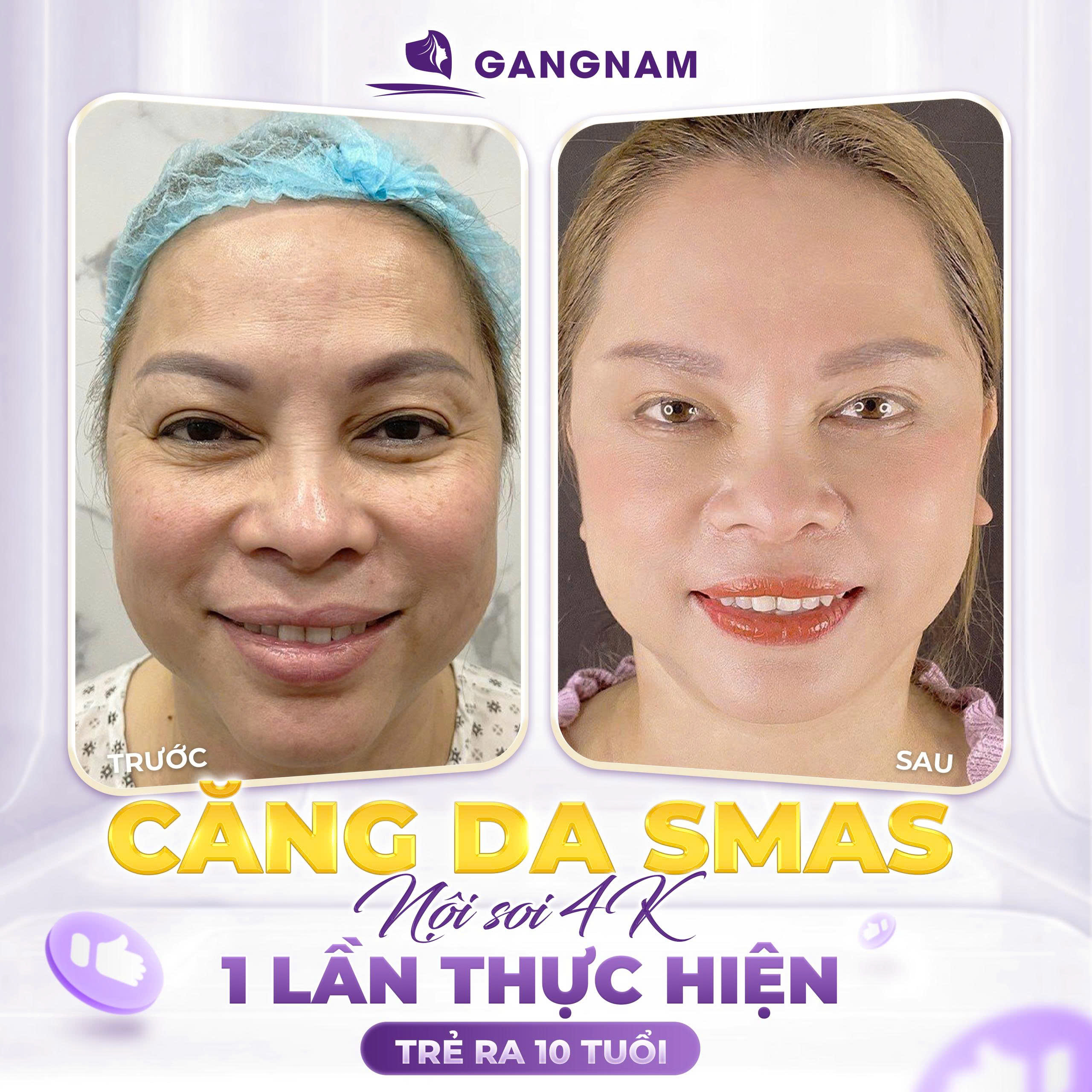 Căng da mặt nội soi SMAS 4K: Bí quyết trẻ hóa toàn diện và bền vững 6 Thẩm mỹ Gangnam – Tiêu chuẩn làm đẹp hiện đại