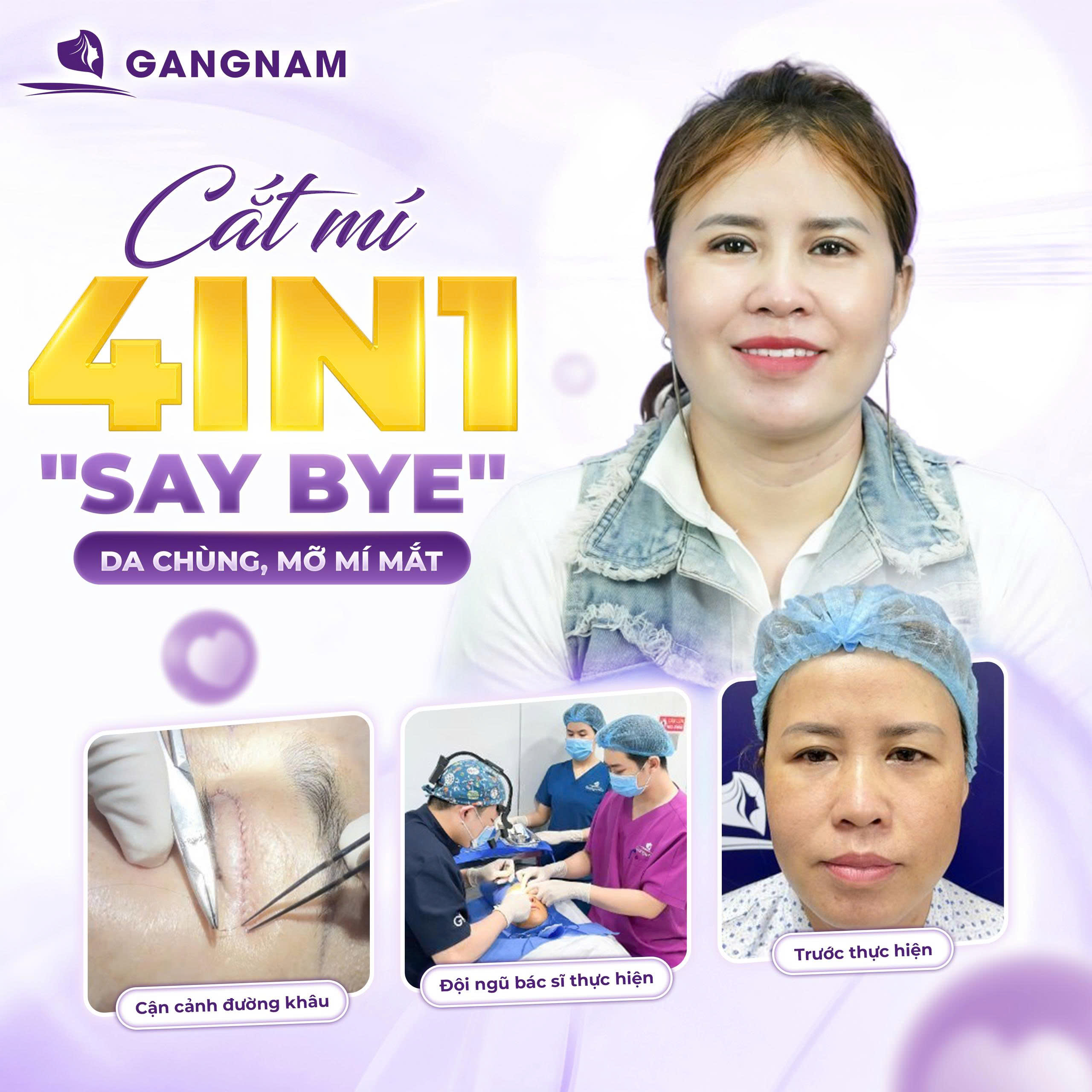 Cắt mí 4in1 trẻ hóa vùng mắt: Giải pháp toàn diện cho đôi mắt tươi trẻ 6 Cắt mí 4in1 trẻ hóa vùng mắt tại Thẩm mỹ Gangnam