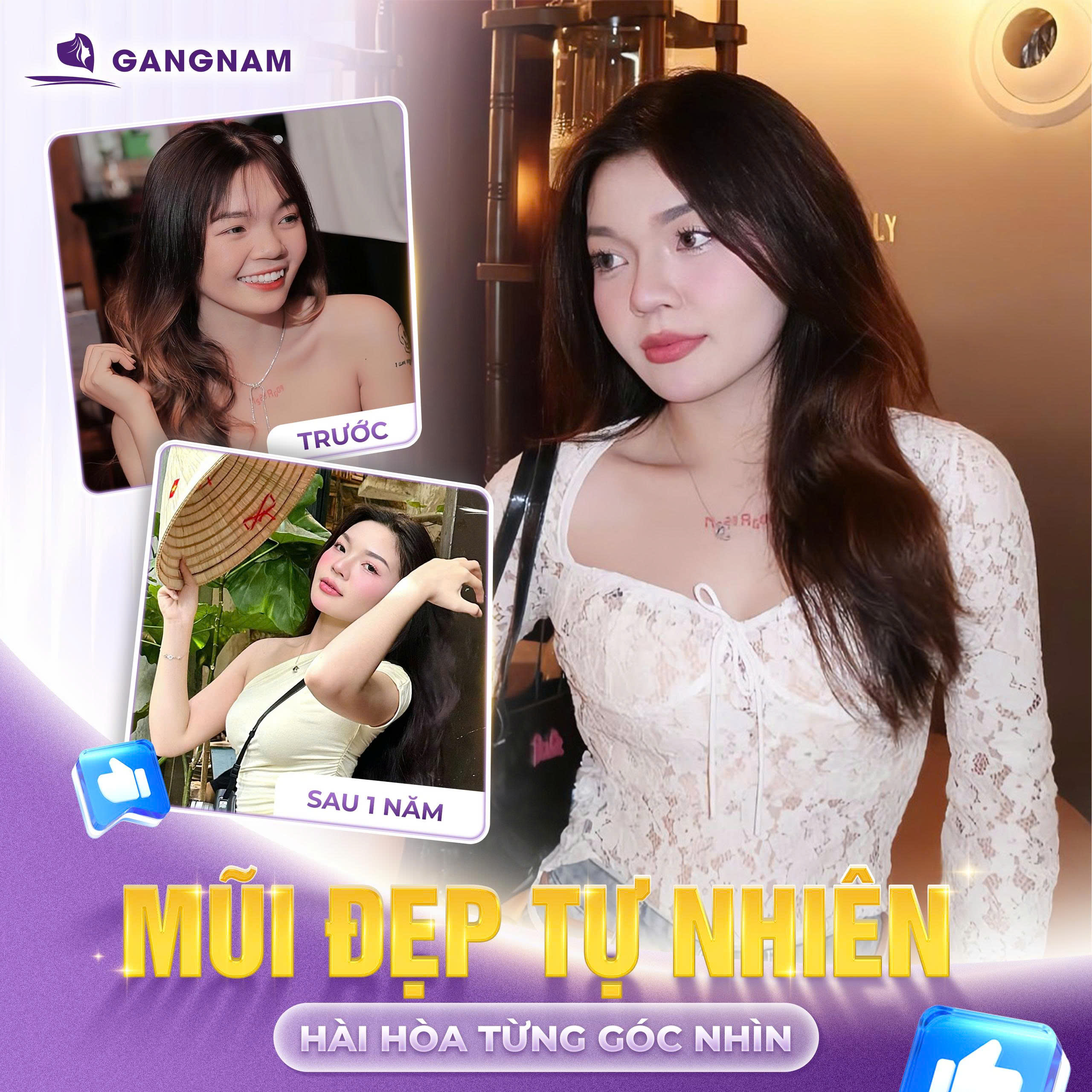 Nâng mũi bọc sụn S-line: Bí quyết sở hữu dáng mũi hoàn hảo tự nhiên 6 Nâng mũi bọc sụn S-line tại Thẩm mỹ Gangnam – Chuẩn tinh tế, chuẩn hài hòa