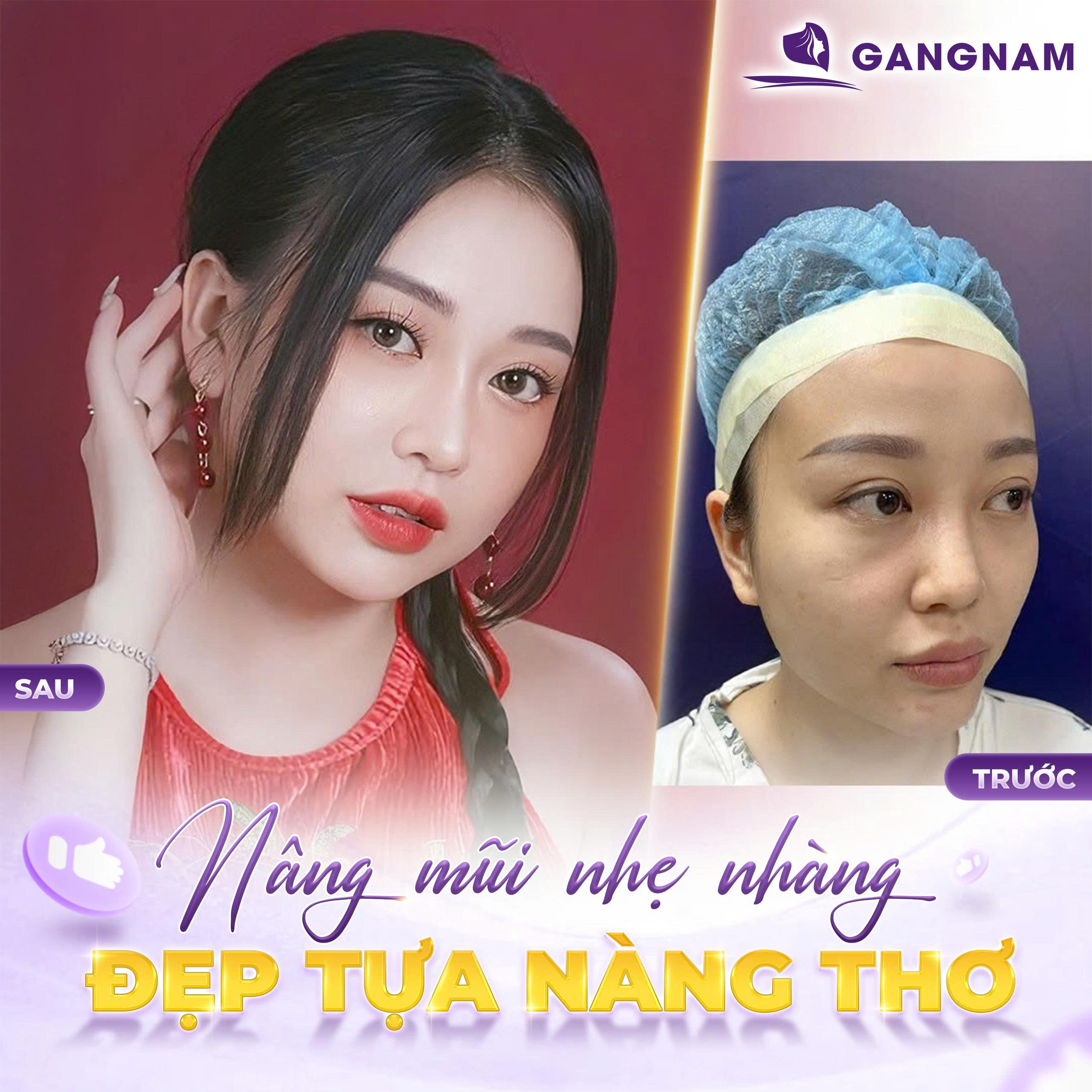 Nâng mũi S line đẹp: Bí quyết sở hữu dáng mũi thanh thoát tự nhiên 6 Thẩm mỹ Gangnam – Địa chỉ nâng mũi S line đẹp uy tín