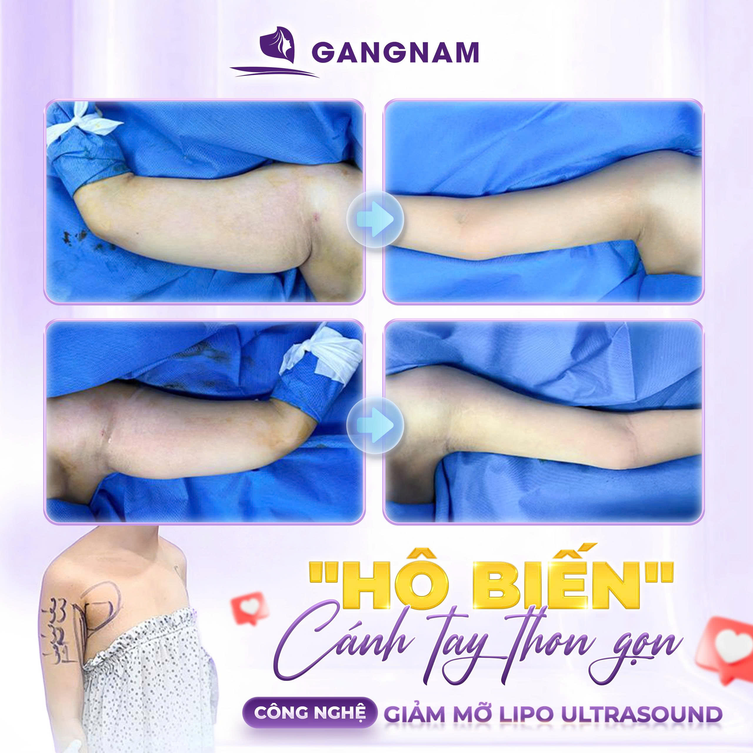 Hút mỡ cánh tay: Giải pháp thon gọn bắp tay an toàn và hiệu quả 4 Lý do mỡ thừa tích tụ ở cánh tay và hút mỡ cánh tay là giải pháp tối ưu