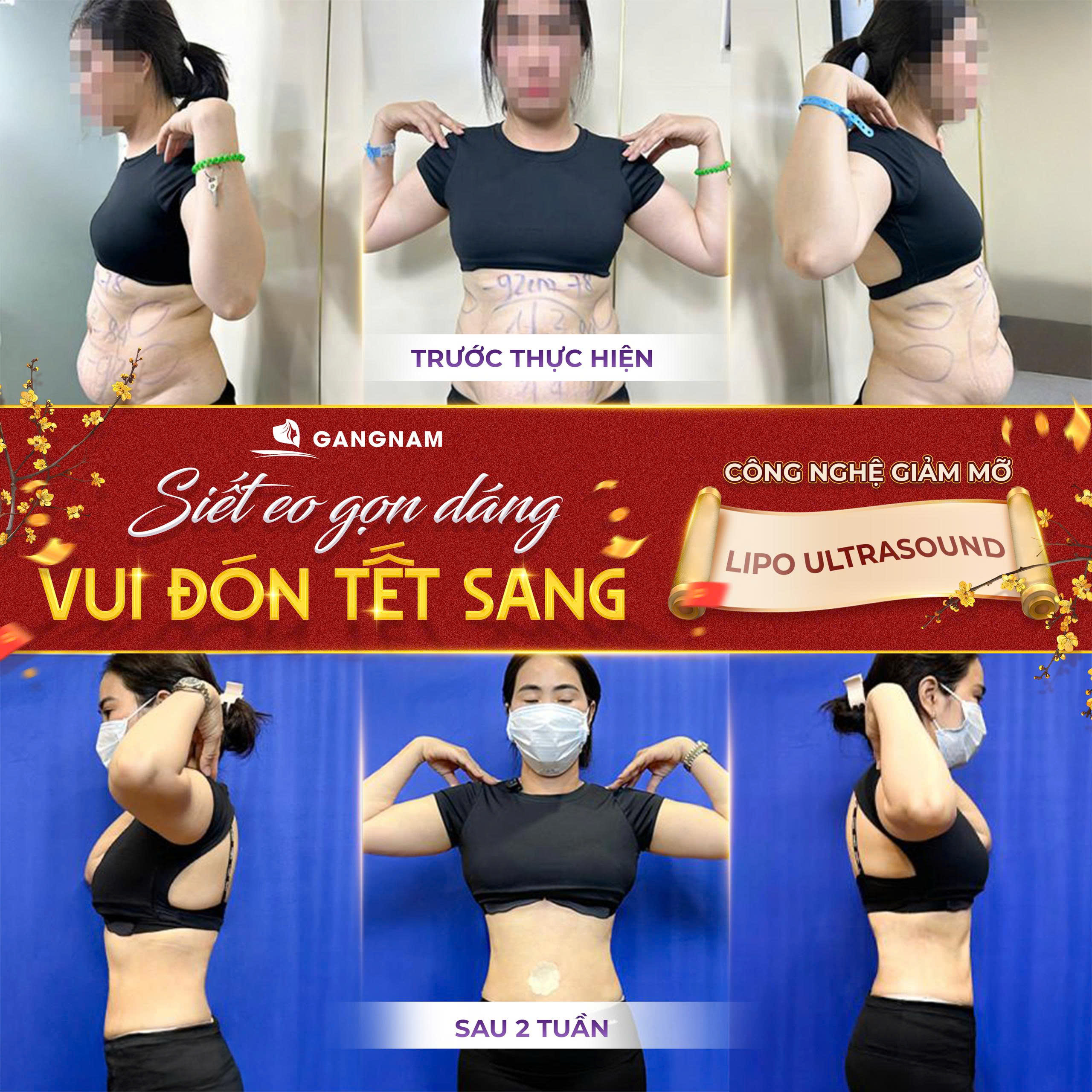 Hút mỡ eo Lipo Ultrasound: Giải pháp hiện đại cho vòng eo thon gọn hoàn hảo 6 Thẩm mỹ Gangnam – Địa chỉ hút mỡ eo Lipo Ultrasound uy tín