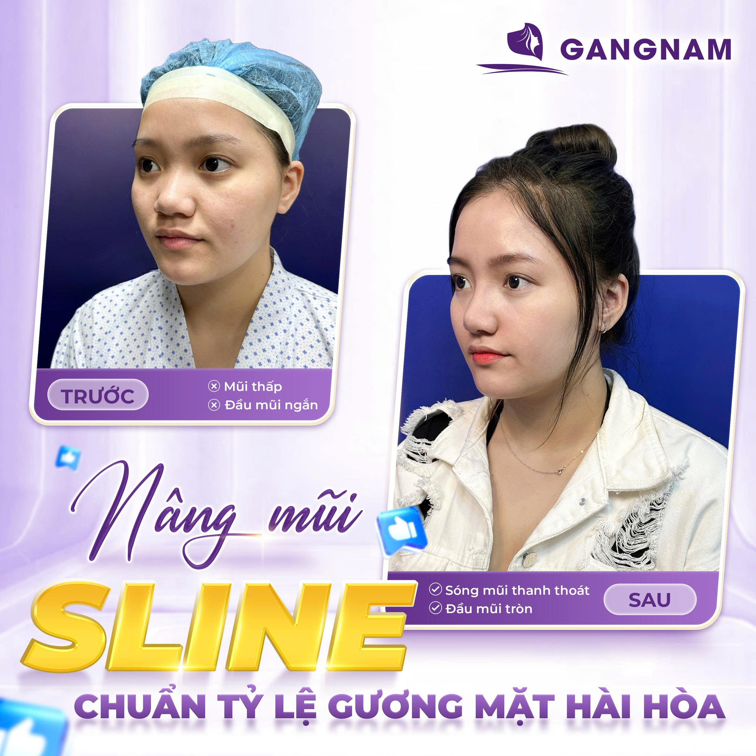 Nâng mũi S line đẹp: Bí quyết sở hữu dáng mũi thanh thoát tự nhiên 5 Ưu điểm vượt trội khi nâng mũi S line đẹp