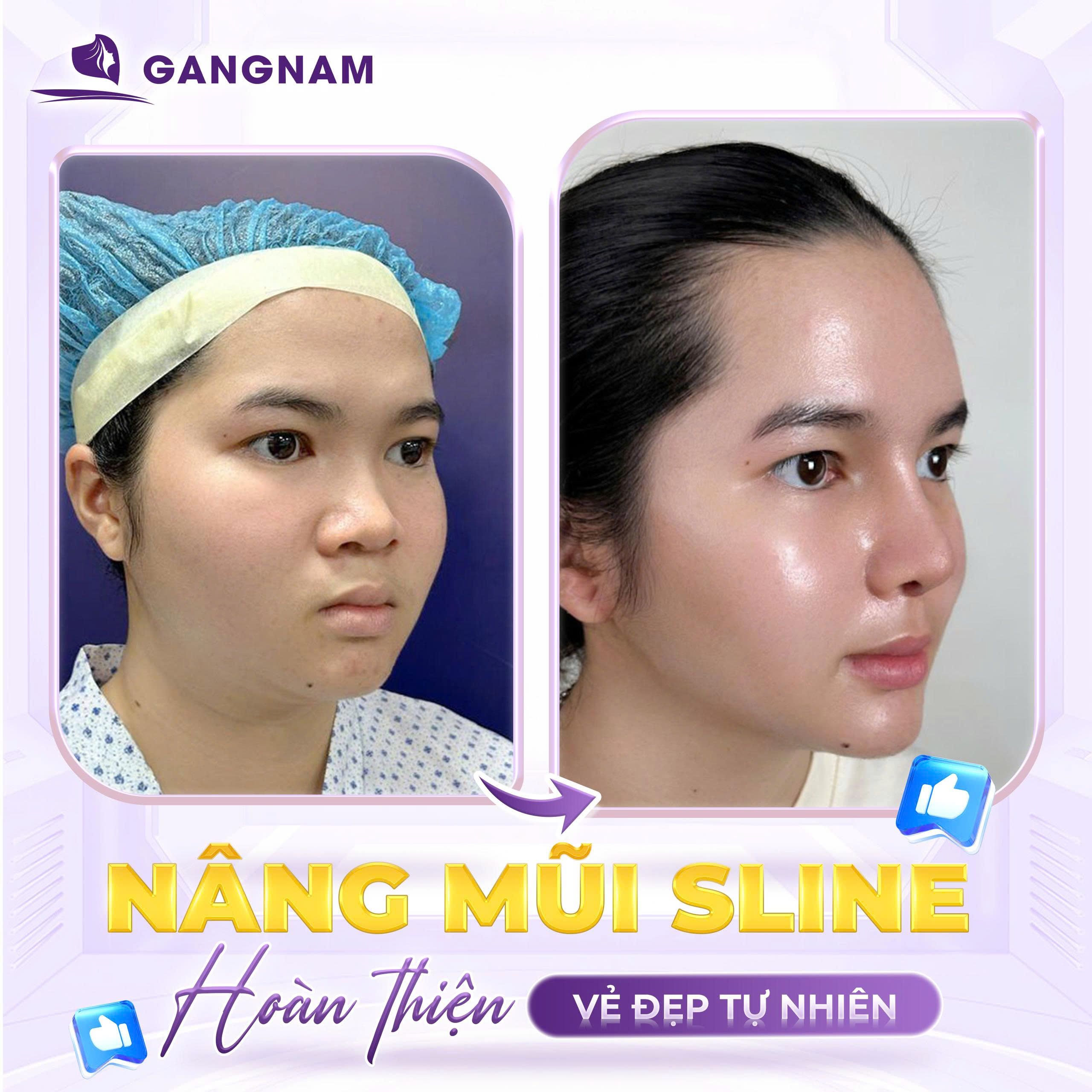 Nâng mũi S line dáng tự nhiên – Sống mũi mềm mại, hài hòa khuôn mặt Á Đông 4 Đặc điểm nổi bật của nâng mũi S line dáng tự nhiên