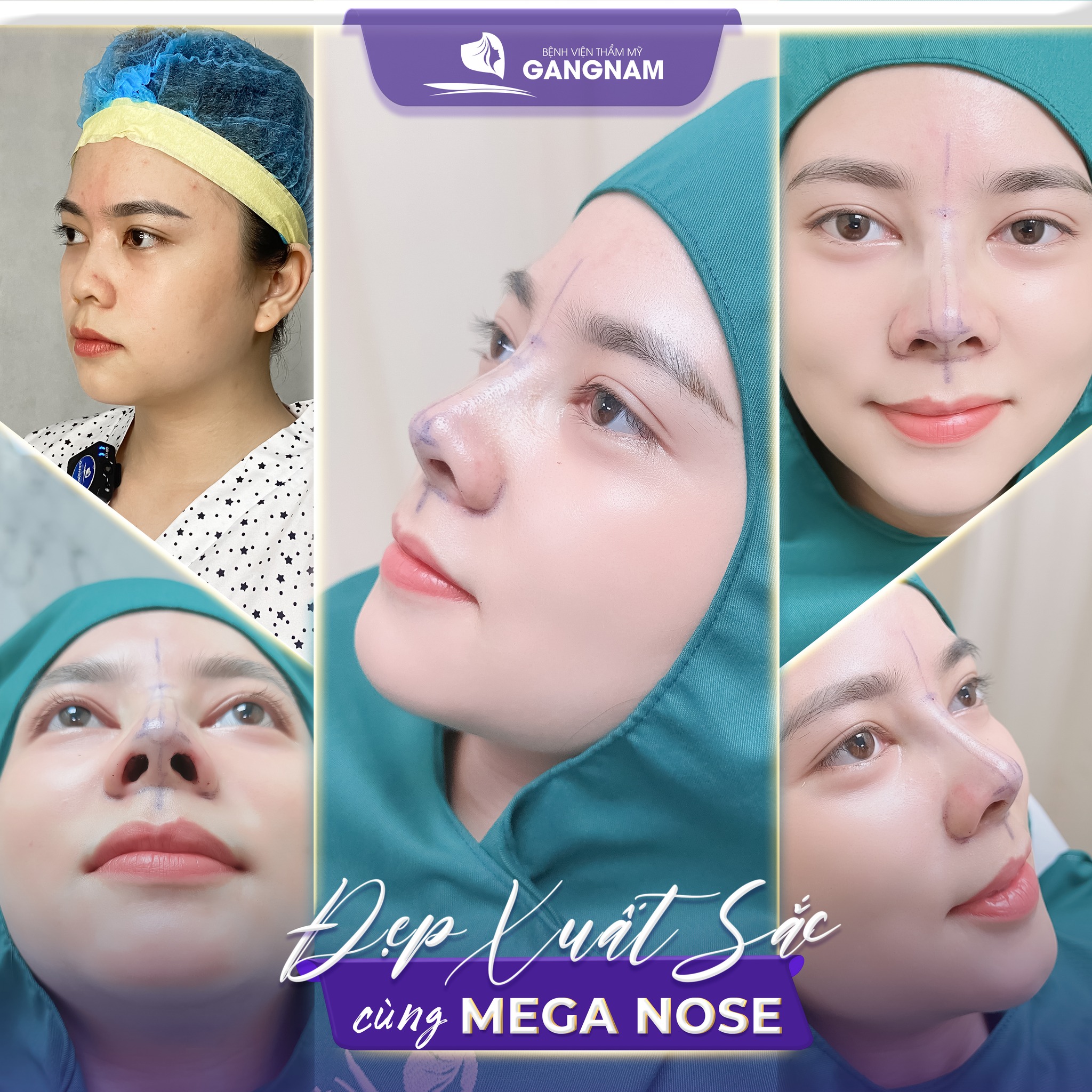 Nâng mũi công nghệ Mega Nose – Giải pháp hoàn hảo cho dáng mũi tự nhiên 5 Nâng mũi công nghệ Mega Nose – Giải pháp hoàn hảo cho dáng mũi tự nhiên 2