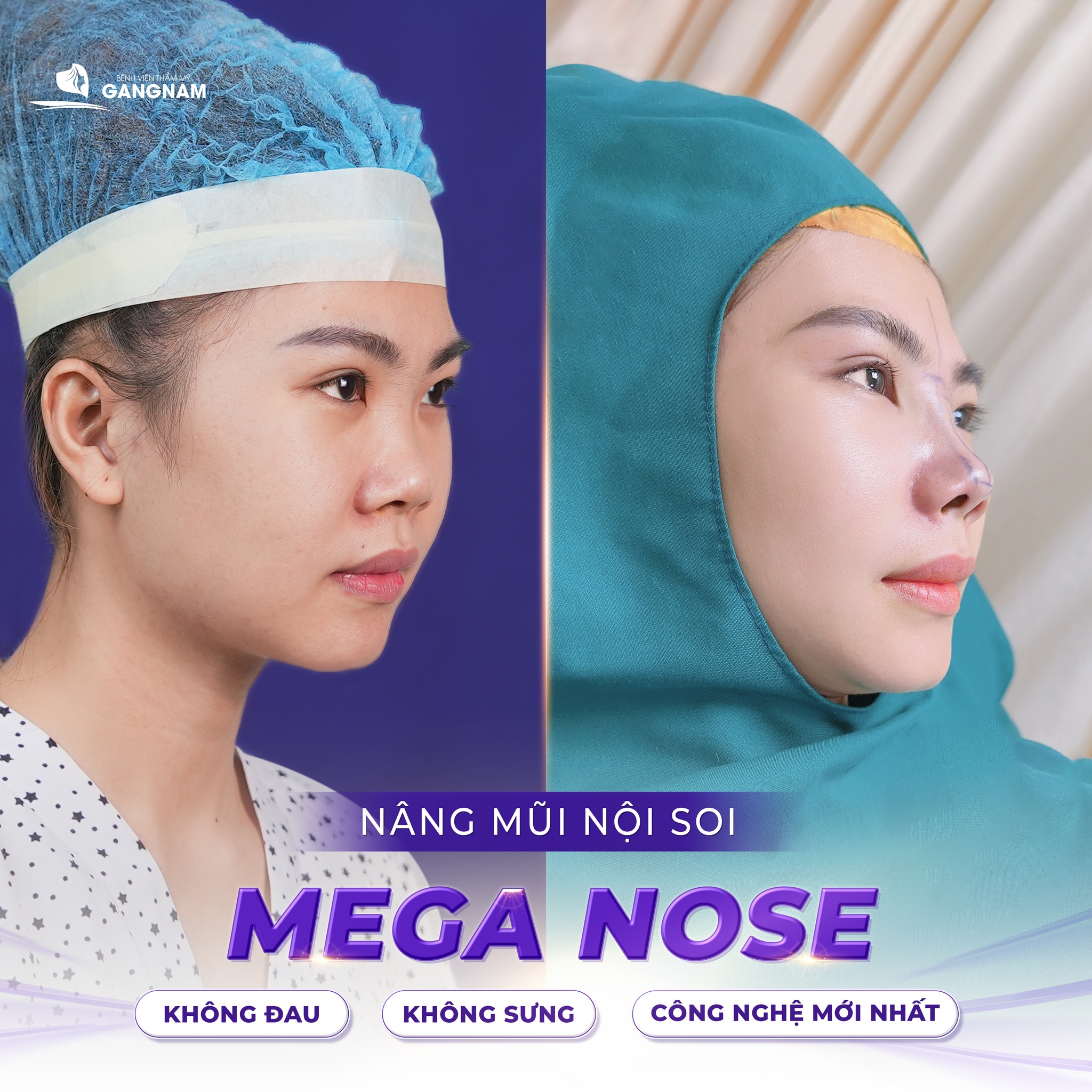 Nâng mũi công nghệ Mega Nose – Giải pháp hoàn hảo cho dáng mũi tự nhiên 6 Thẩm mỹ Gangnam – Tiên phong nâng mũi công nghệ Mega Nose chuẩn y khoa