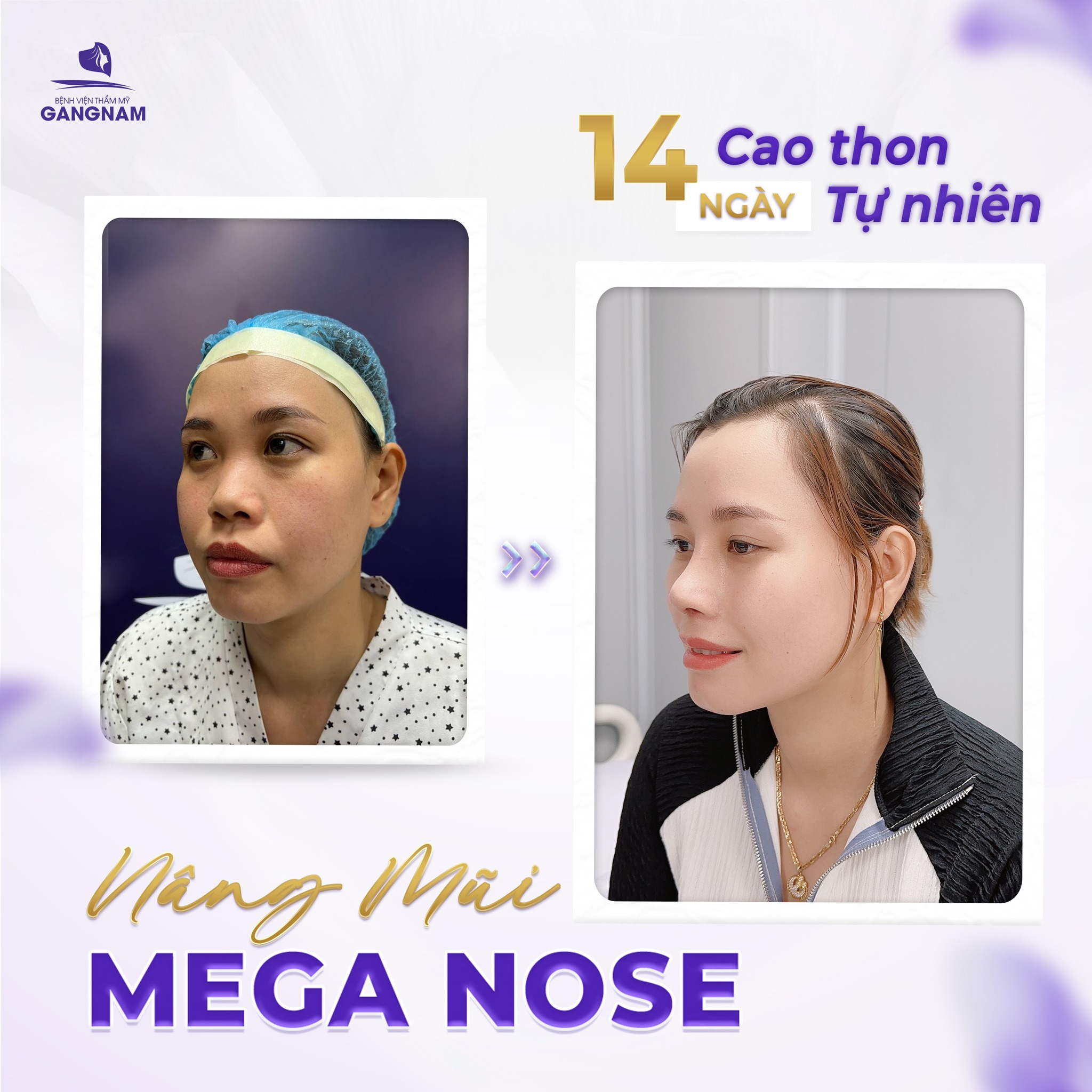 Nâng mũi công nghệ Mega Nose – Giải pháp hoàn hảo cho dáng mũi tự nhiên 4 Nâng mũi công nghệ Mega Nose là gì?