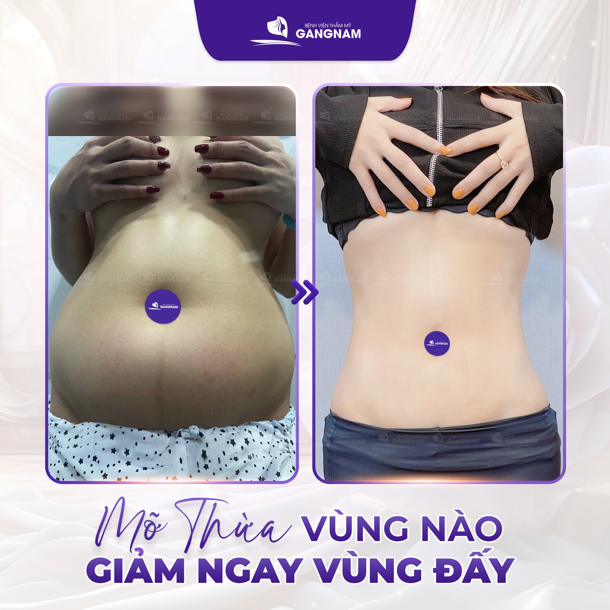 Giảm mỡ hông Lipo – Giải pháp hiện đại cho vòng eo thon gọn hoàn hảo 5 Giảm mỡ hông Lipo – Giải pháp hiện đại cho vòng eo thon gọn hoàn hảo 2