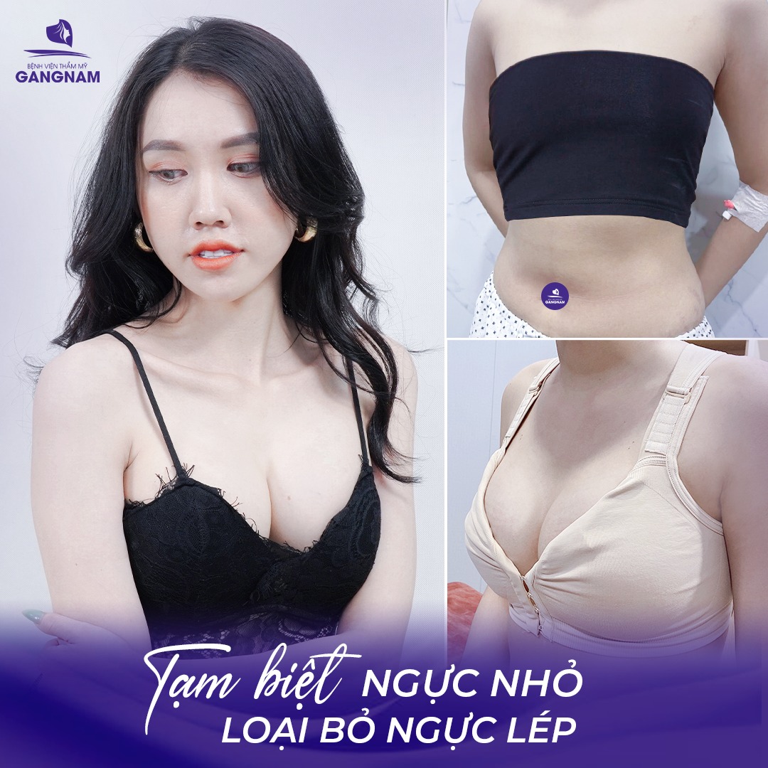 Nâng ngực túi silicon ergonomic – Giải pháp hoàn hảo cho vòng 1 tự nhiên 6 Nâng ngực túi silicon ergonomic tại Thẩm mỹ Gangnam