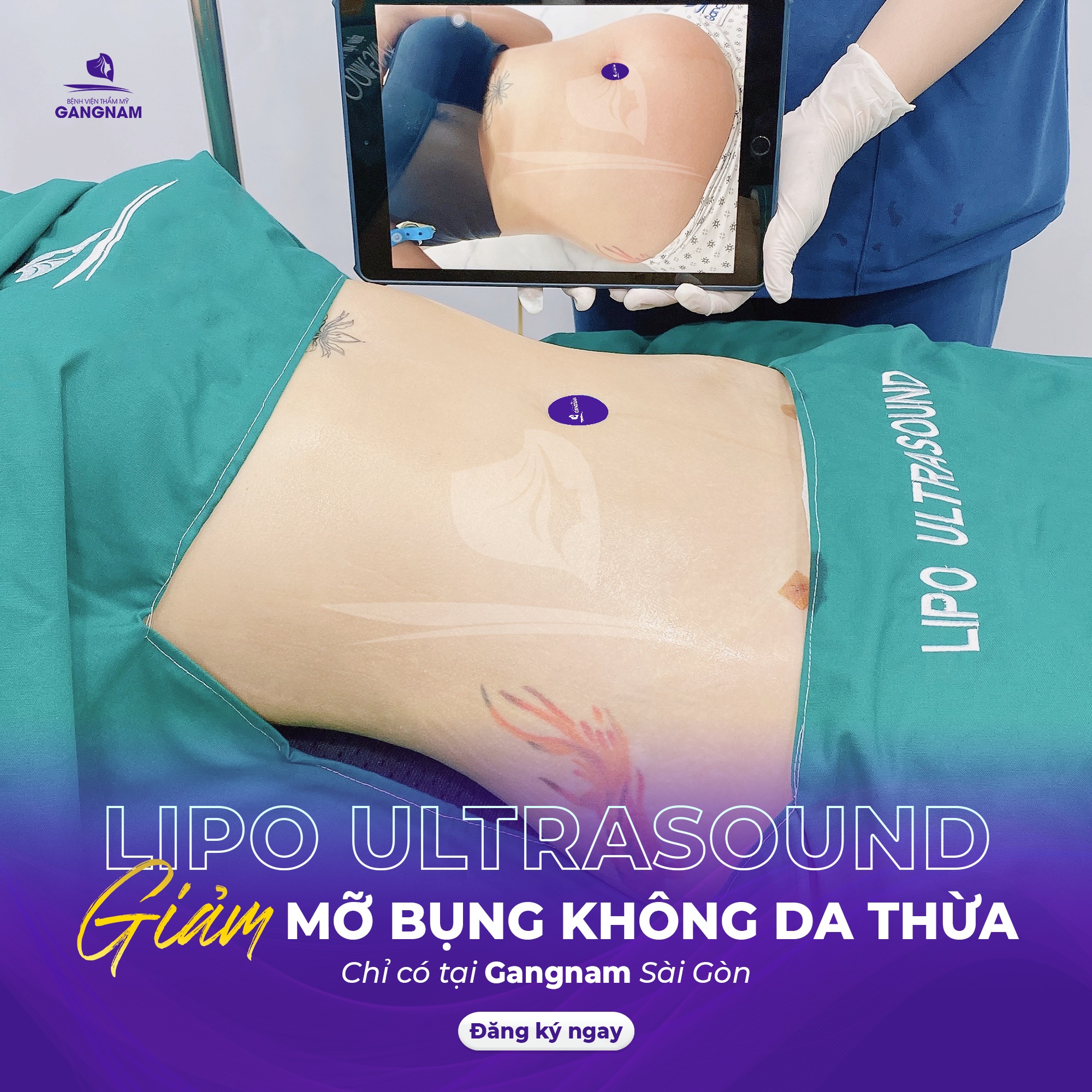 Hút mỡ bụng Lipo Ultrasound: Cơ chế hoạt động, ưu điểm và quy trình chuẩn y khoa 6 Thẩm mỹ Gangnam – Chuẩn mực an toàn và vẻ đẹp tự nhiên